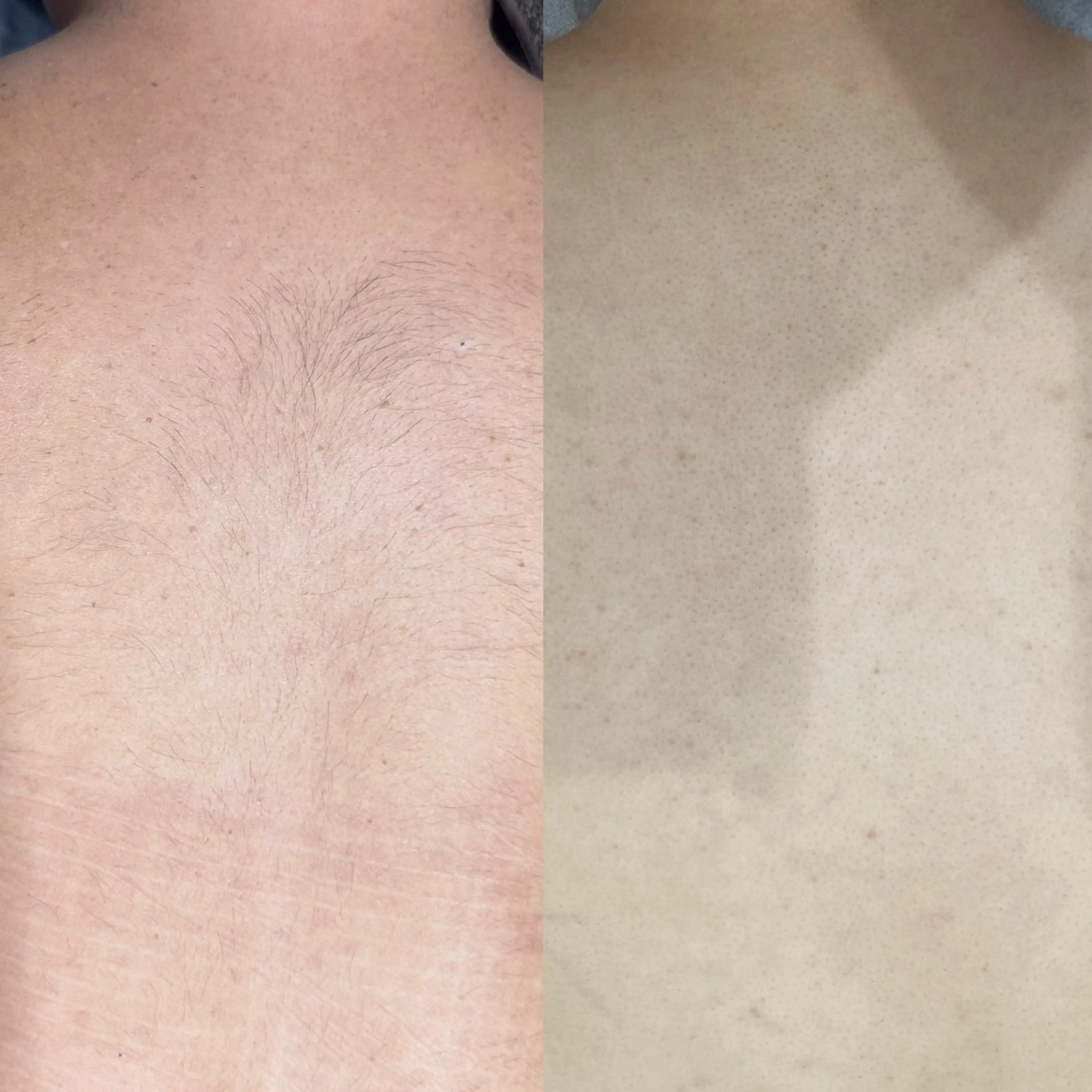 【イベント前に🌈】うなじ＋背中脱毛の写真