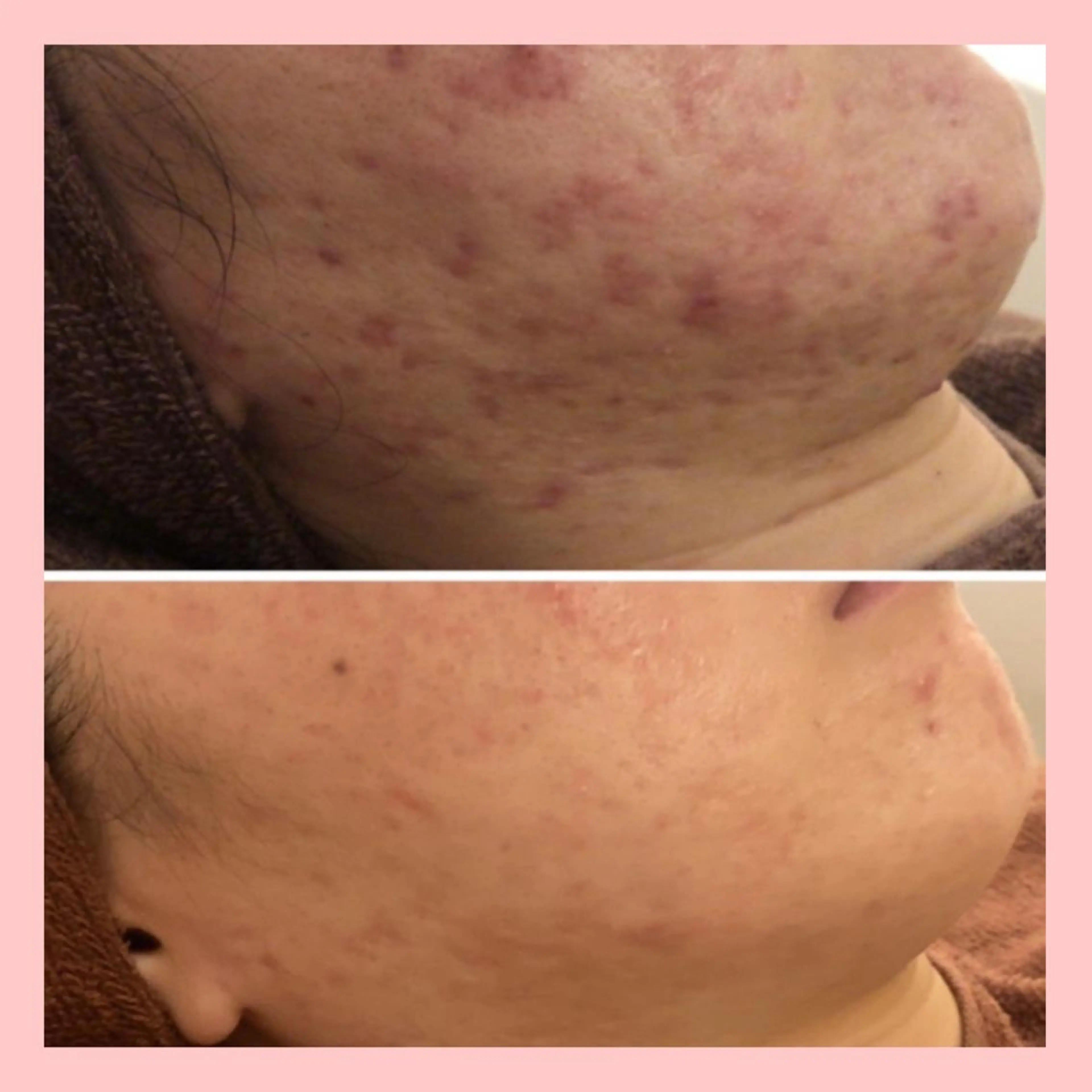 セミロング カラー パーマ ヘアアレンジ メンズ キッズ ネイル マツエク・マツパ アイブロウ 🔥3か月で肌革命 🔥ニキビ専門店のエステ・リラクイメージ