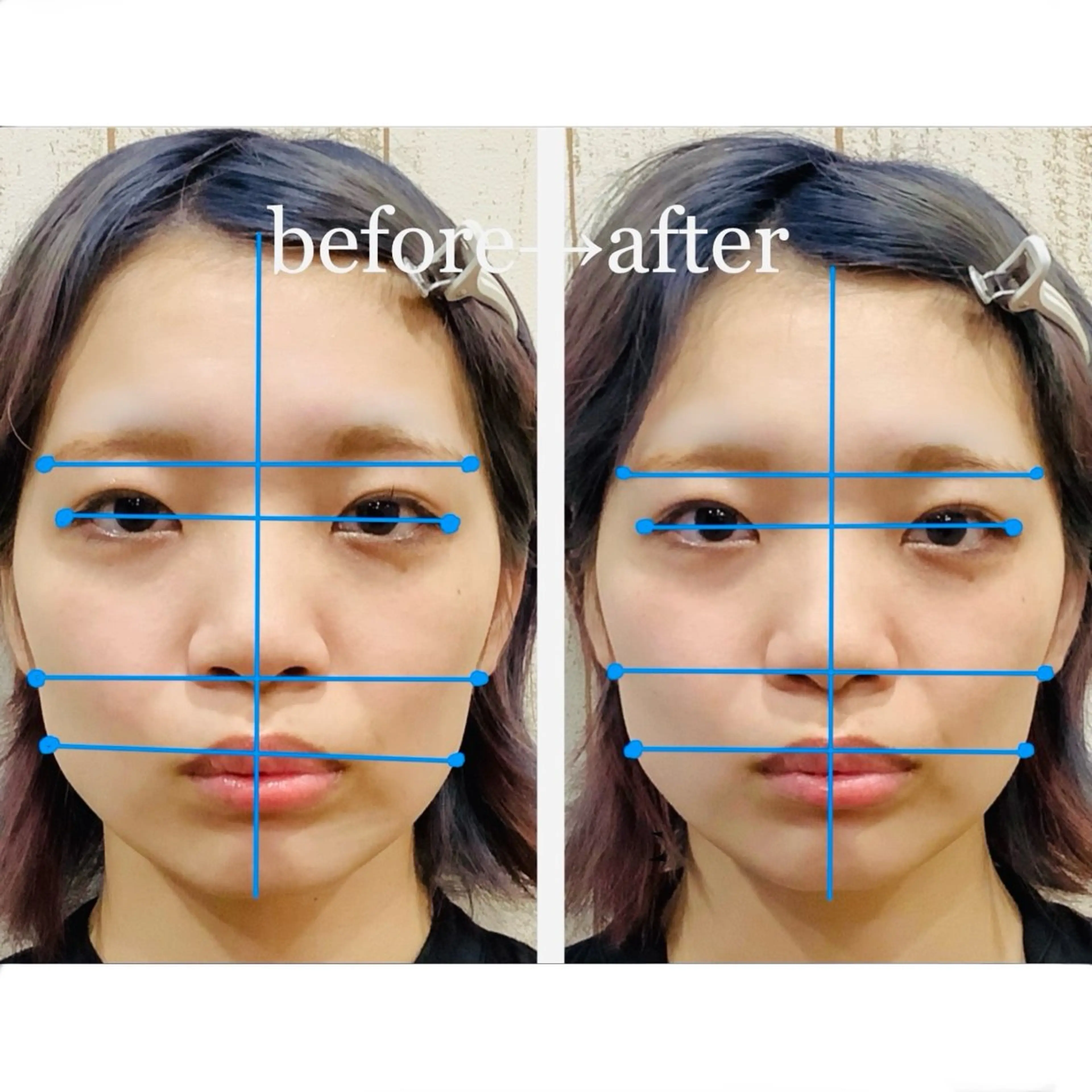 エステ リラク 小顔矯正NAKA 筋膜/脂肪/毛穴洗浄のエステ・リラクイメージ