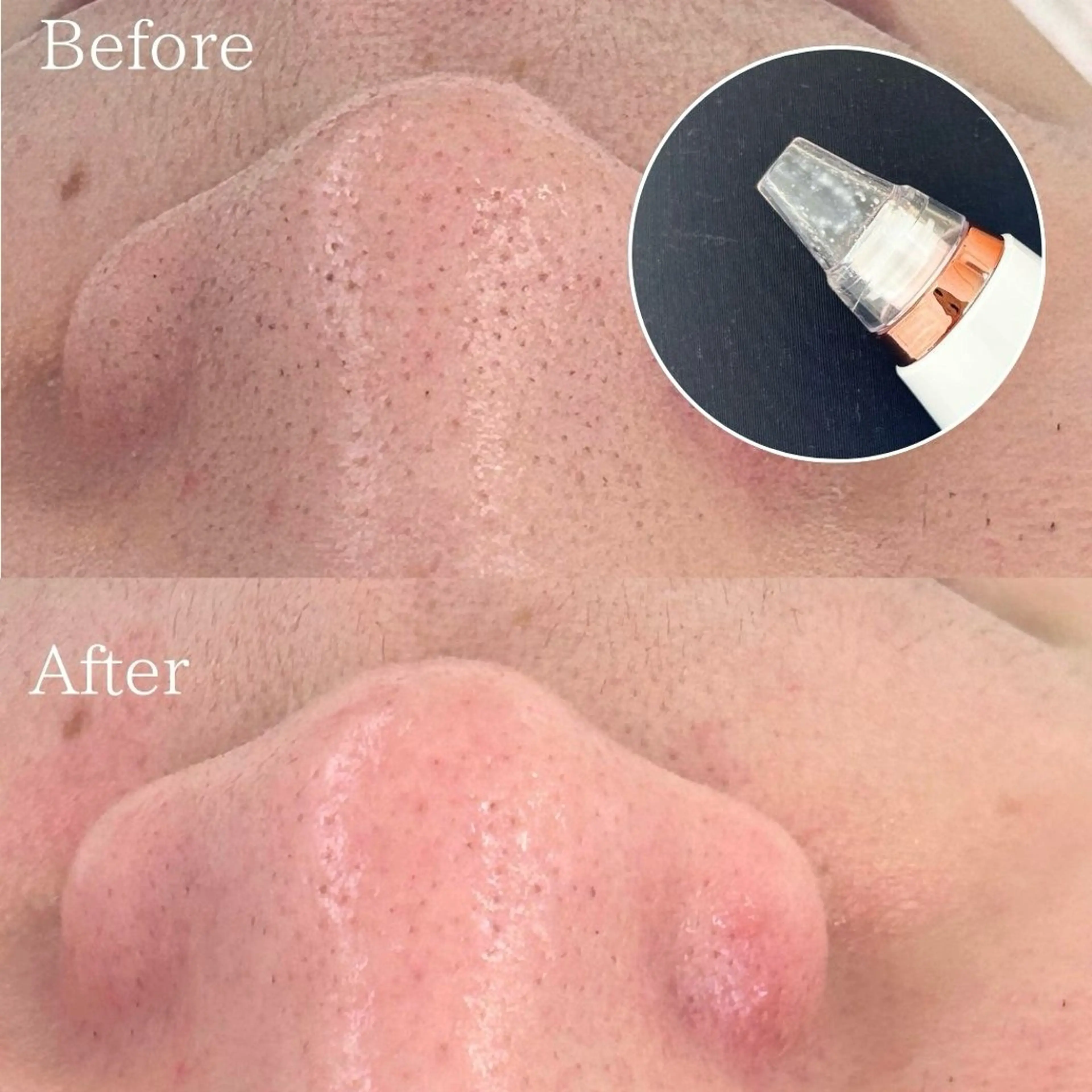 ニョキっと角栓・黒毛穴撃退!!毛穴集中改善フェイシャルの写真