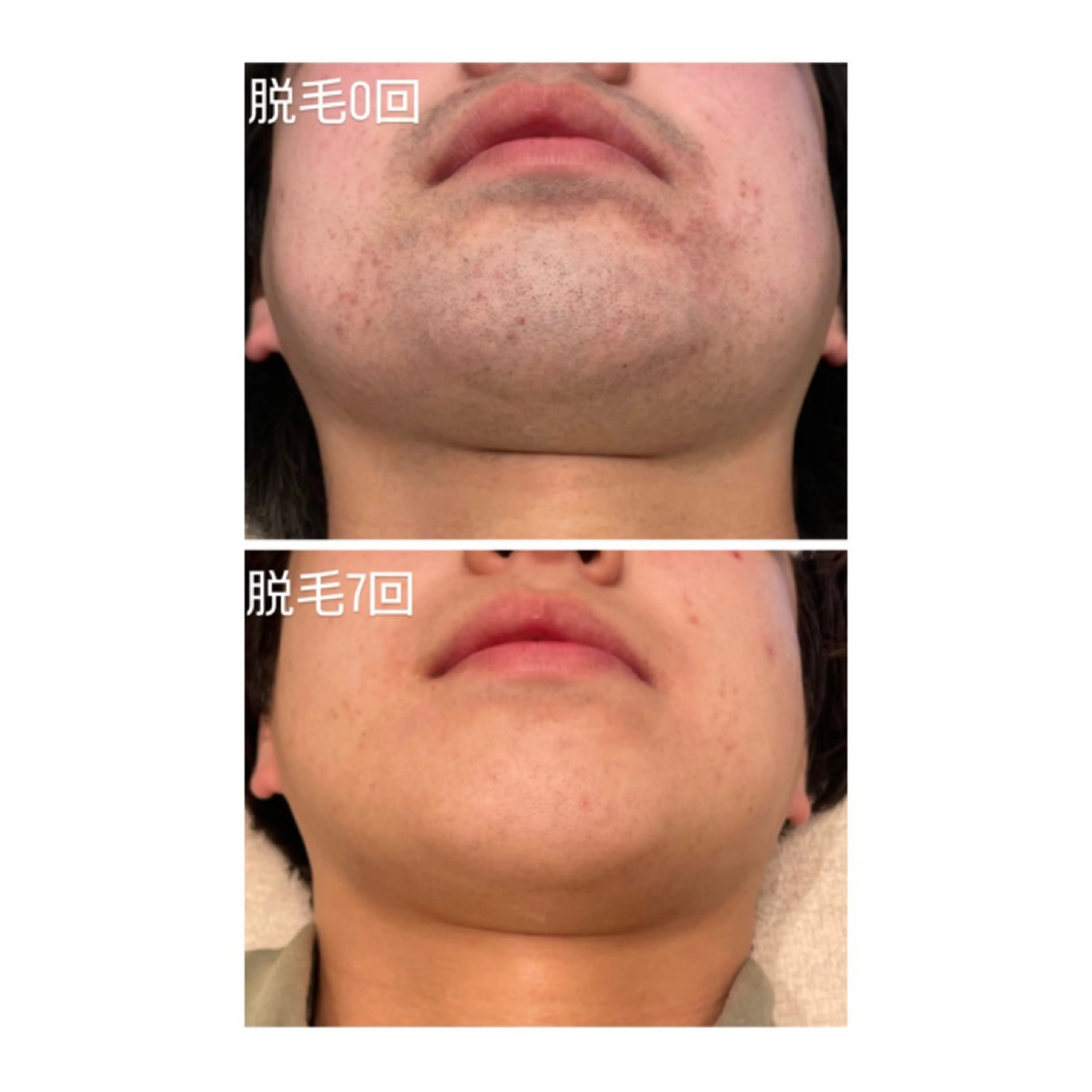 郡山最安値❣️メンズ髭脱毛/目から下首まで👀の写真