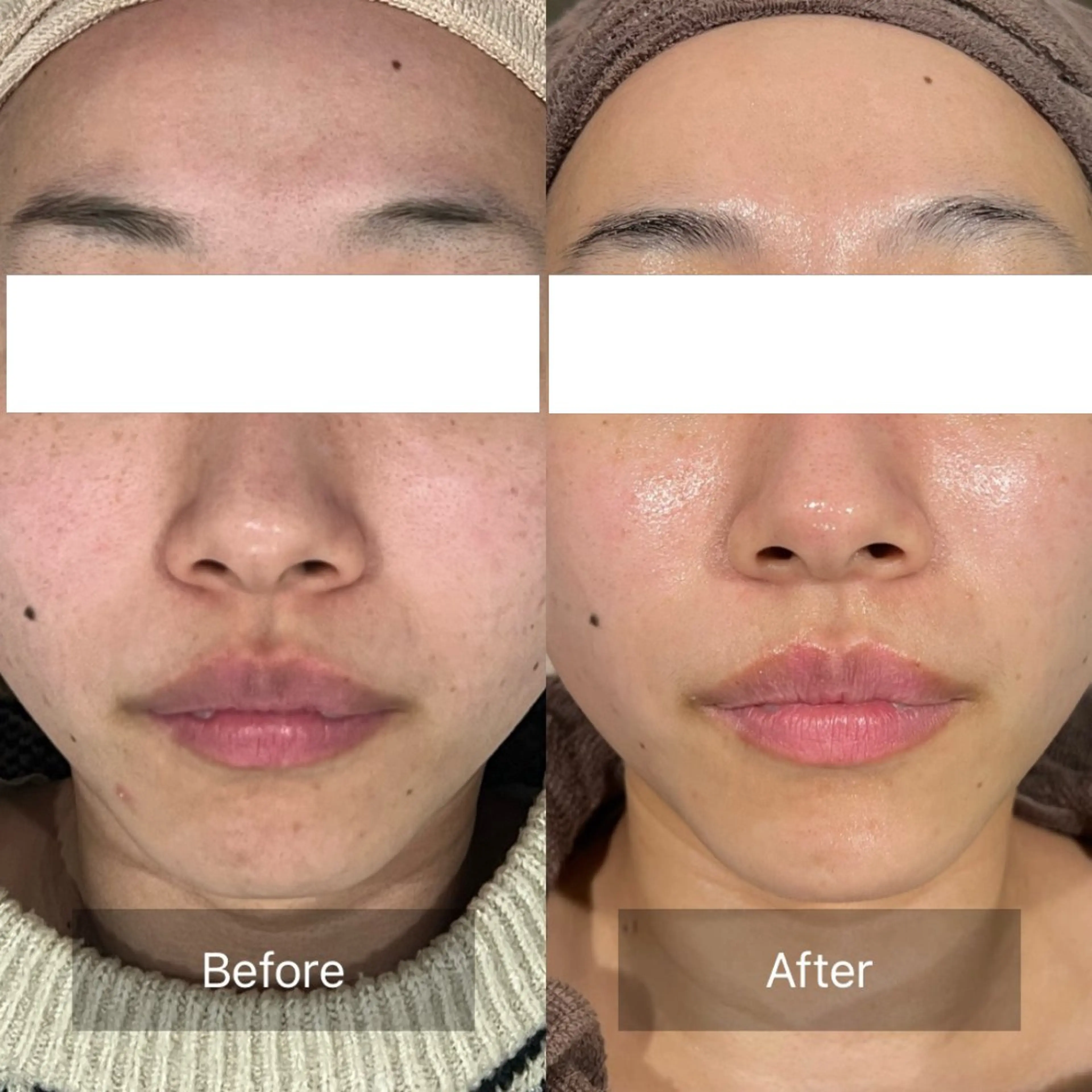 【人気No.1✨】【ご新規様限定】1ヶ月集中モニター🥚最大4回のエステ付きの写真