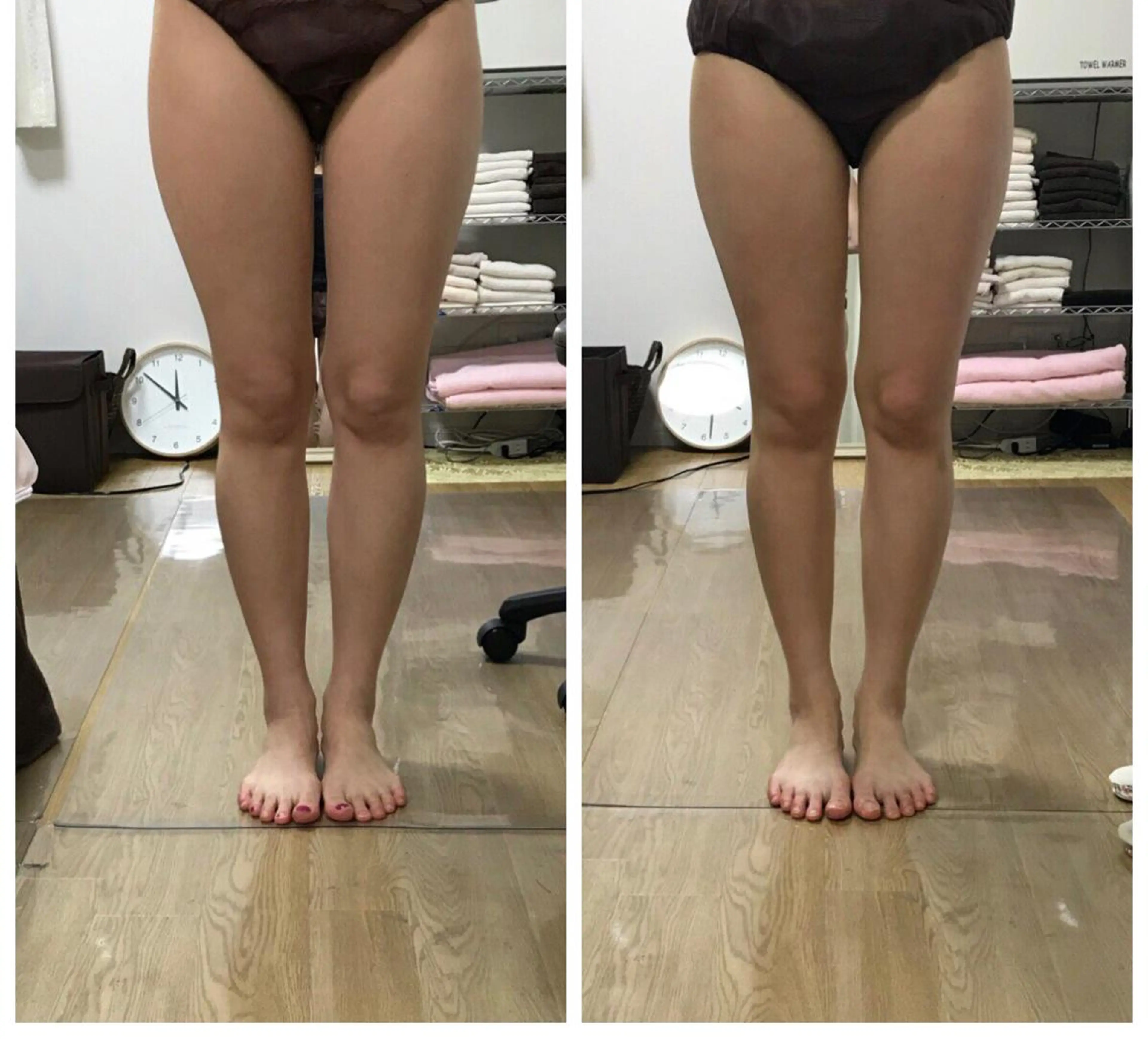 キャビテーション➕ラジオ波➕赤色LED同時出力のキャビフル 70分 選べる2箇所♬ 【ご新規様限定】の写真