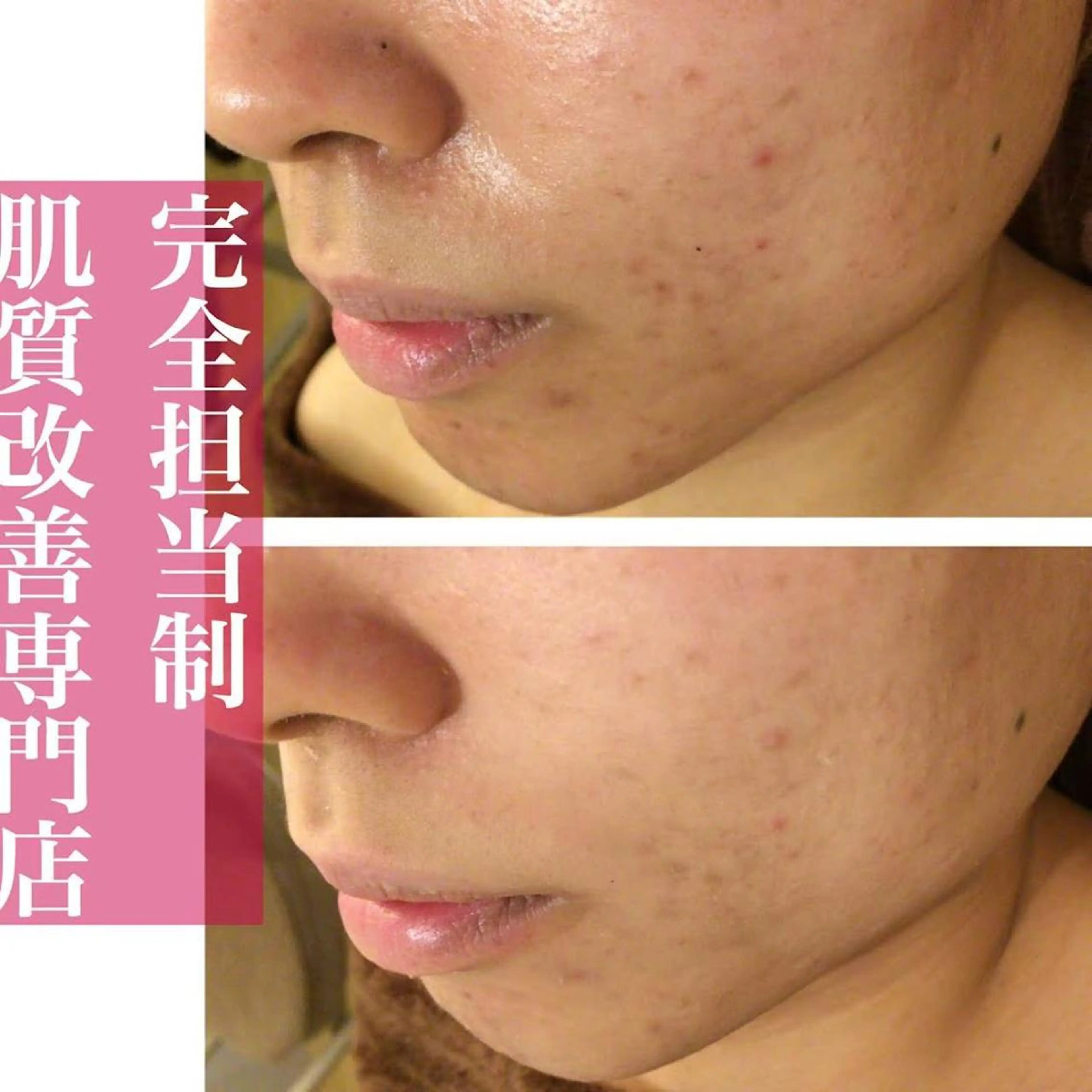 セミロング カラー パーマ ヘアアレンジ メンズ キッズ ネイル マツエク・マツパ 都内で出来る肌管理! 最短ニキビ改善のエステ・リラクイメージ