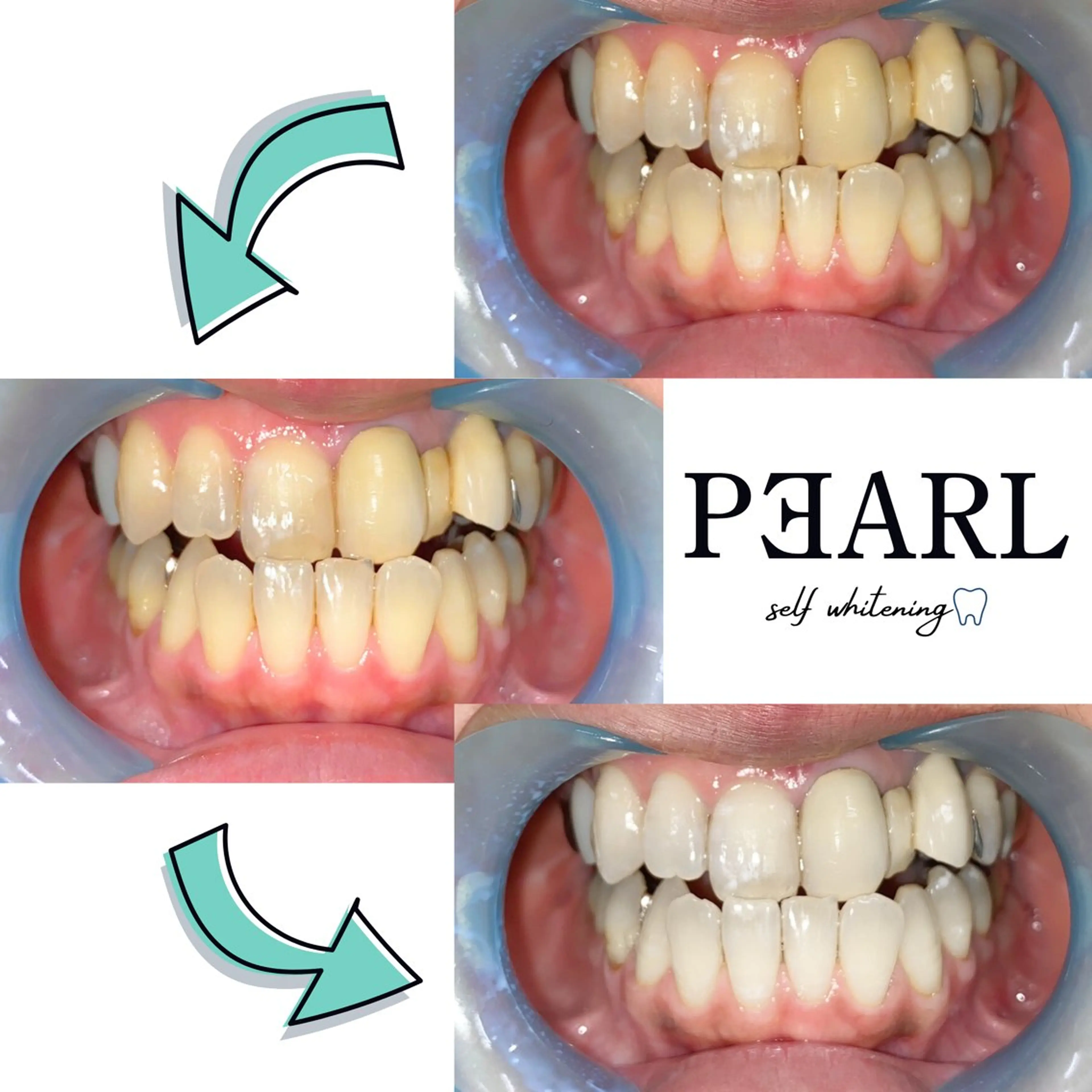 お得✨【口コミ必須】【初回お試し体験⭐︎】プレミアムホワイトニング¥3,700⇨¥1,000！！初回2トーンアップ多数✨の写真