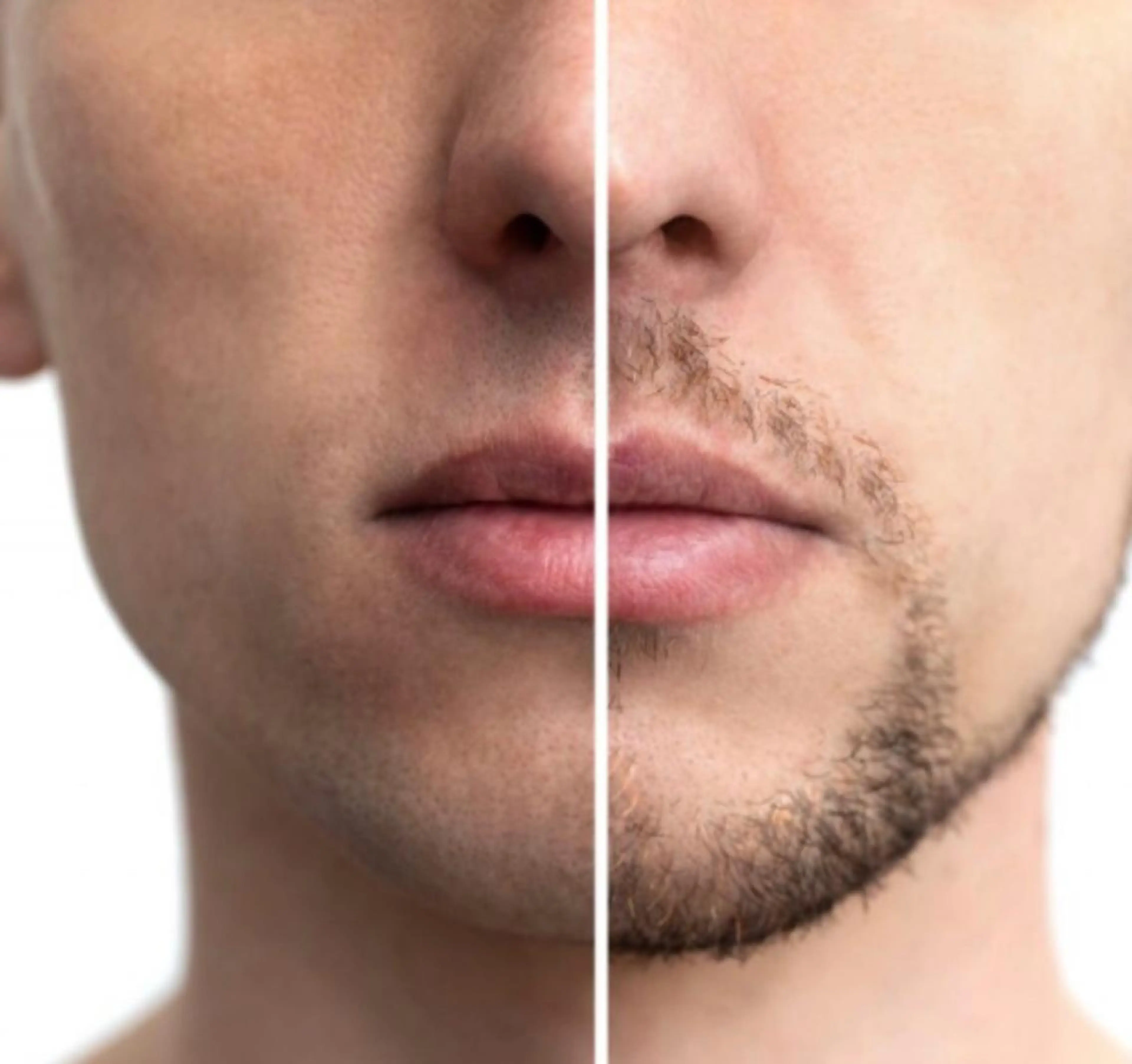 【人気No.1】男性:ひげダブル脱毛の写真