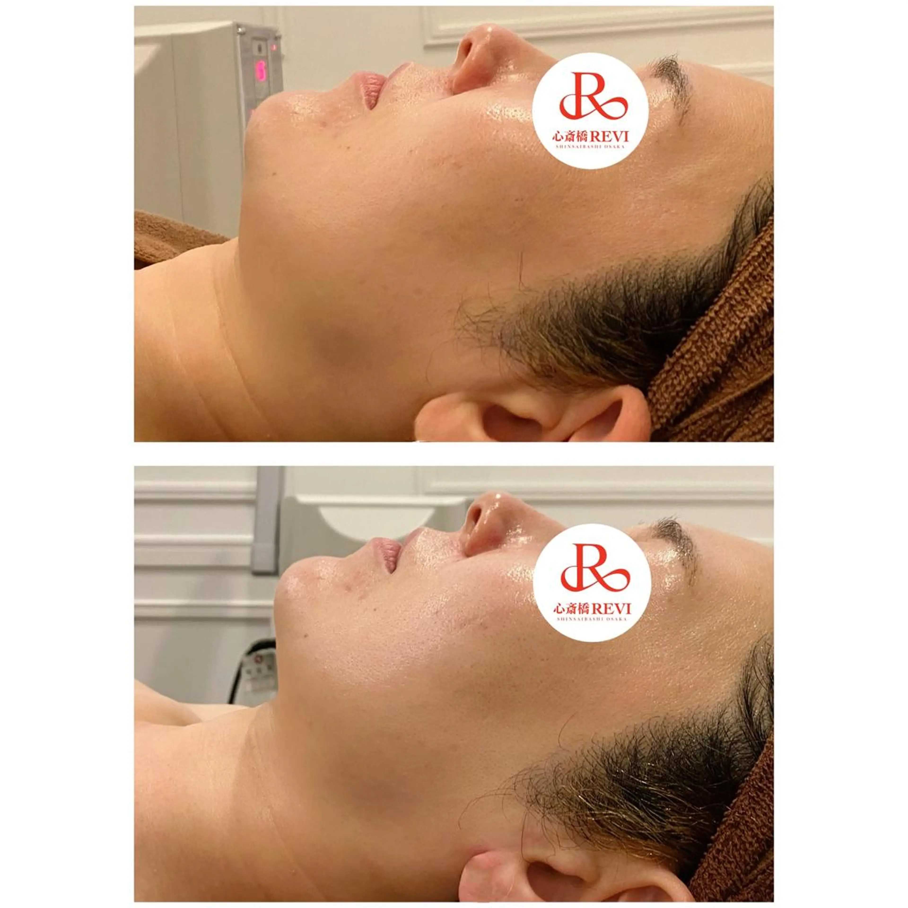 【毛穴×ハイパーナイフEX小顔】毛穴レス透明肌フェイシャル🤍毛穴づまりを徹底オフしてつるん肌✨の写真