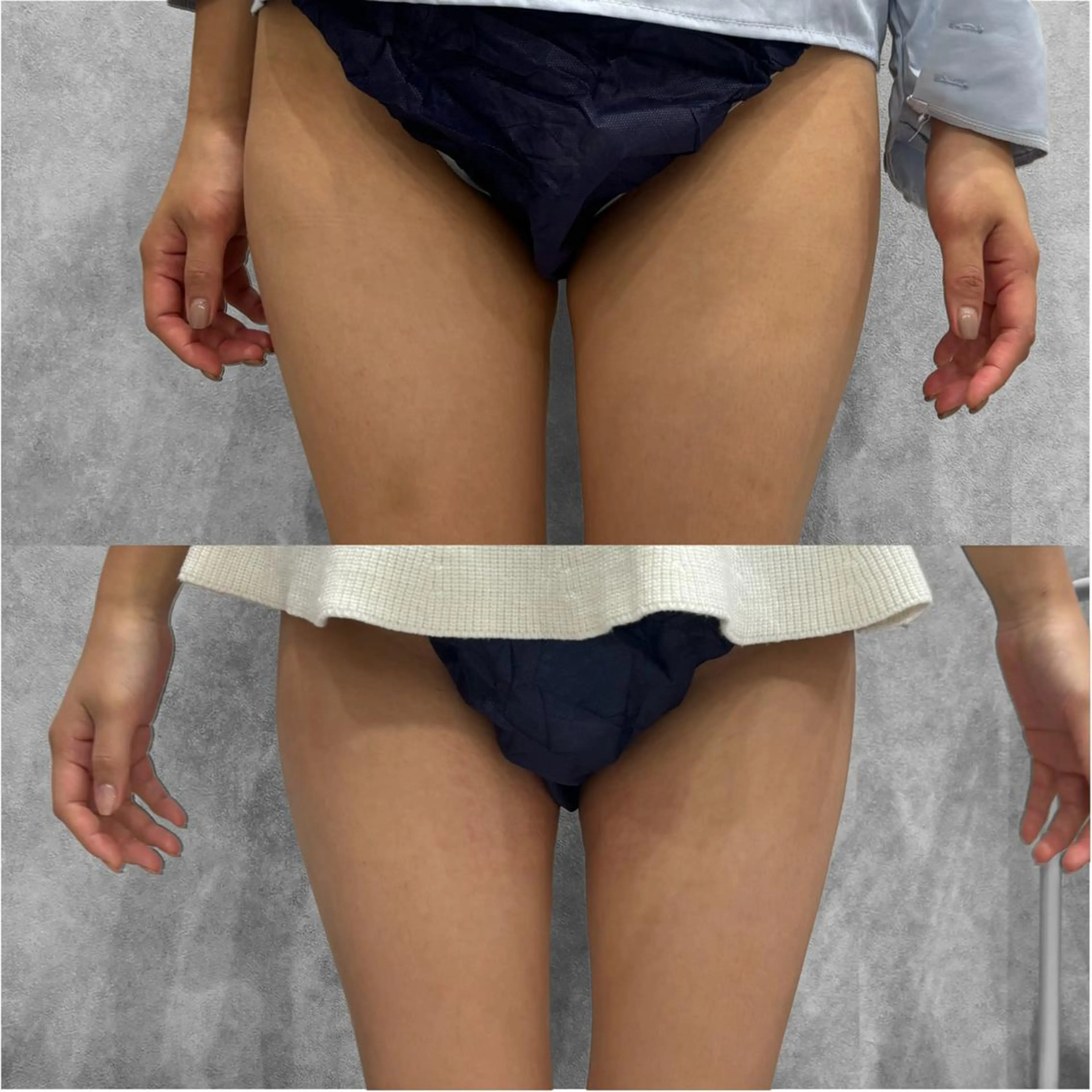 【しっかり変化】8cc｜二の腕や内ももなど本気の脂肪ケア🍋の写真