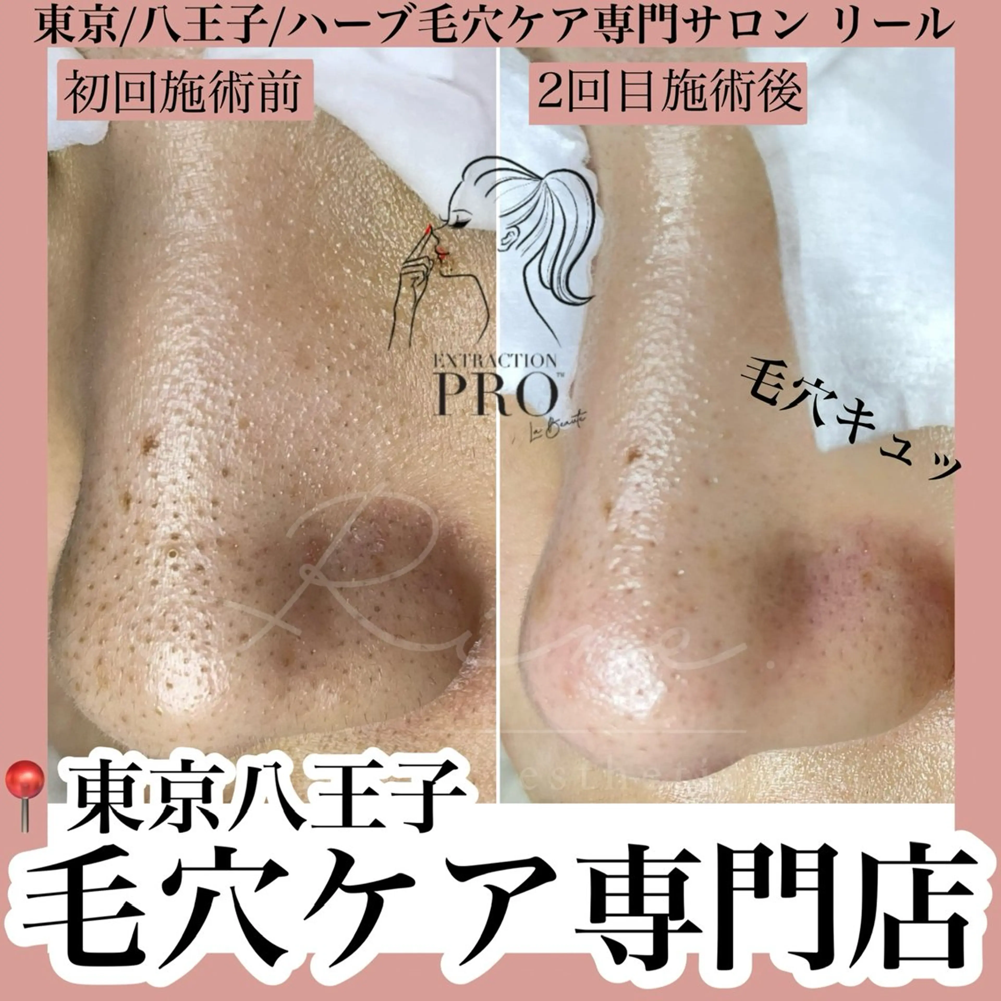 毛穴改善コース⚠️必ず注意事項をご一読くださいの写真