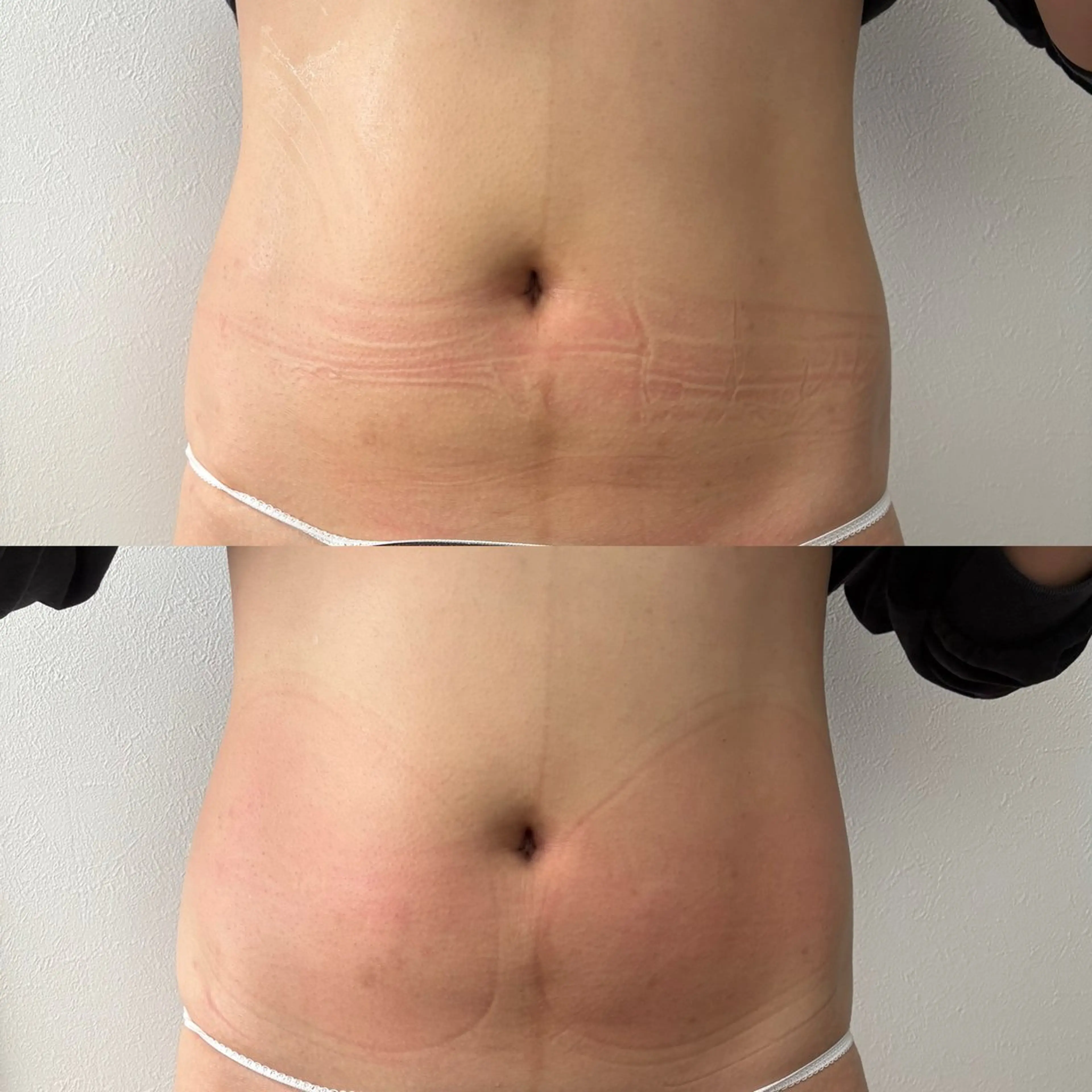 Miiju.所属・Miiju. 石巻市 脂肪冷却  鈴木のエステ・リラクイメージ