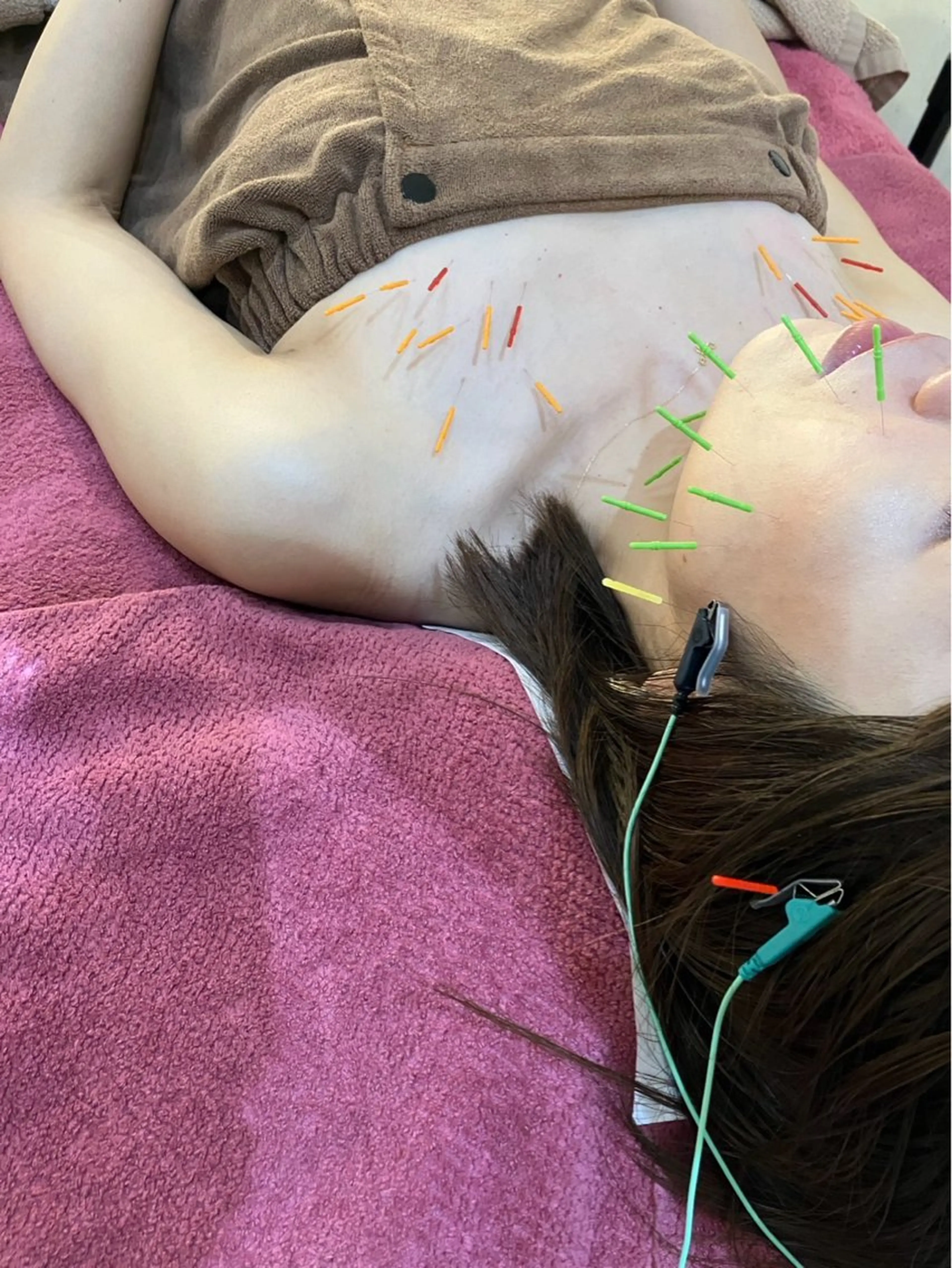 【NEW】バストケア鍼✨美容鍼灸スペシャルコースの写真