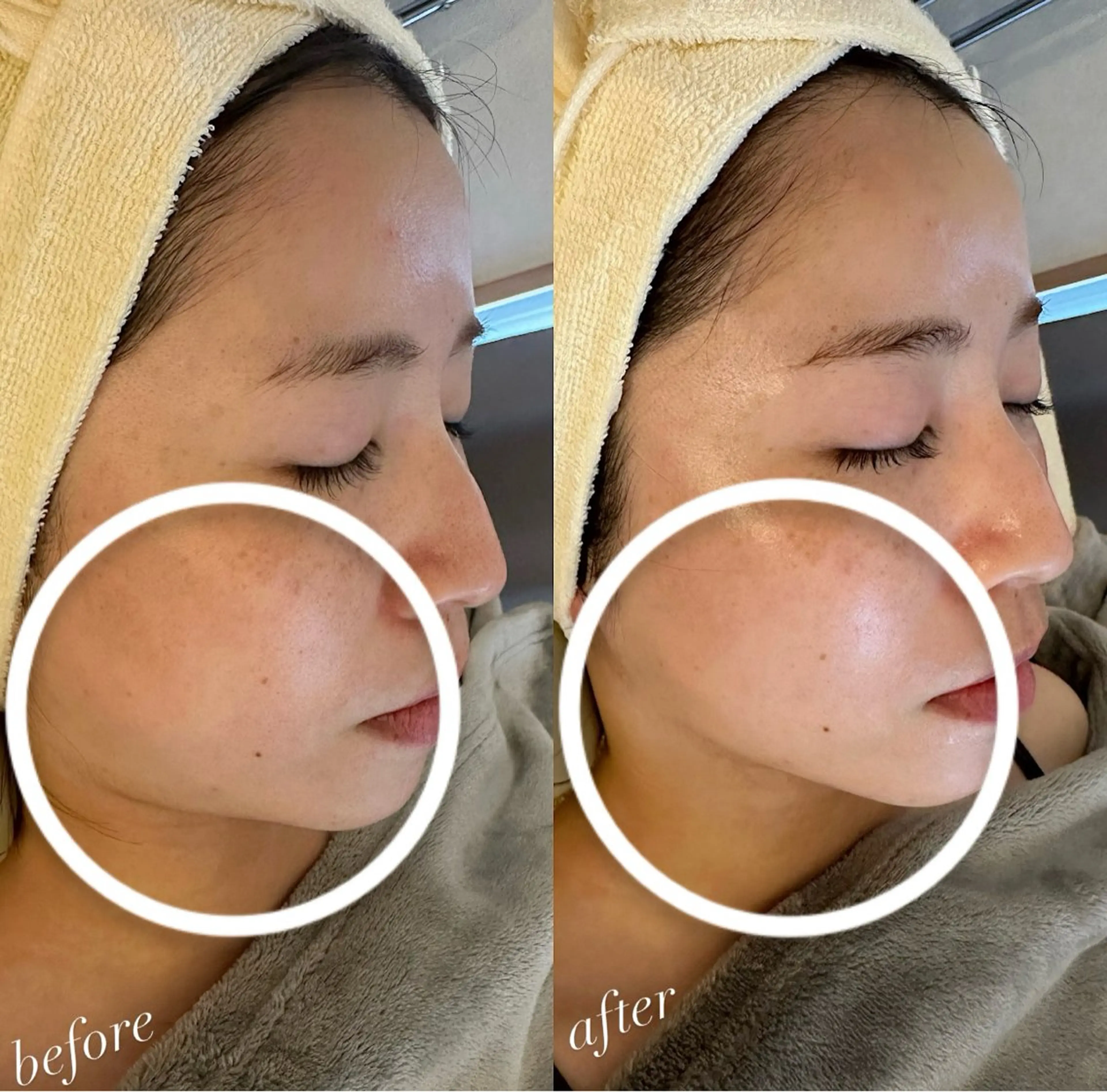 『水光ジェット(無針注射)×エニシーグローパック‎°•*⁀⭐️』(ダウンタイム＋痛みなし)#肌質改善 #フェイシャルの写真