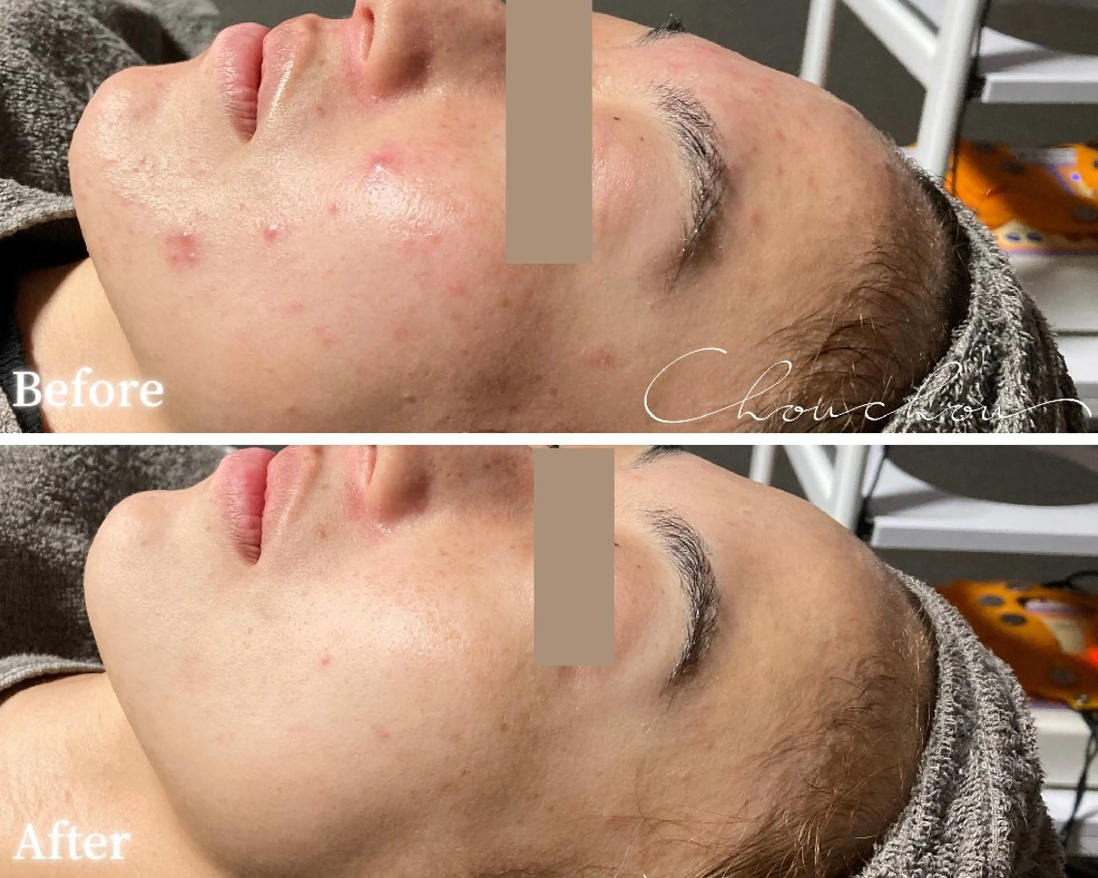 beauty & health salon Chou chou所属・ニキビ・毛穴🌿肌を 育てるララピール✨のエステ・リラクイメージ