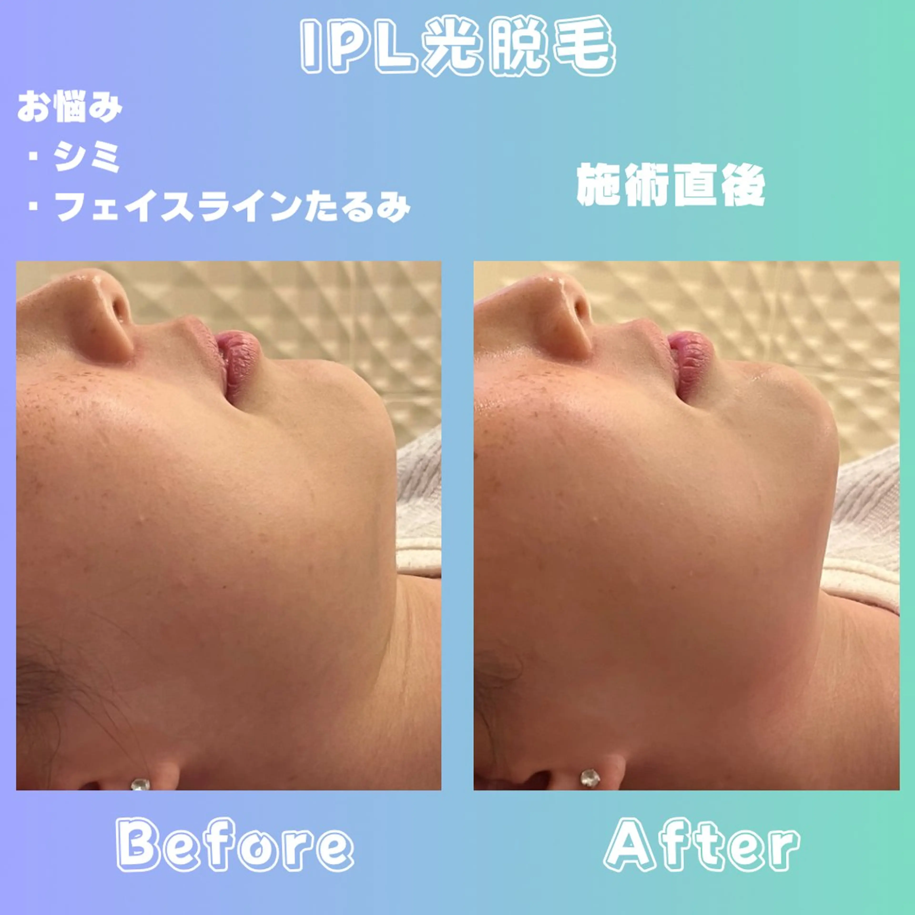 効果重視脱毛サロンRICE所属・肌質改善/都度脱毛 Mahinaのエステ・リラクイメージ