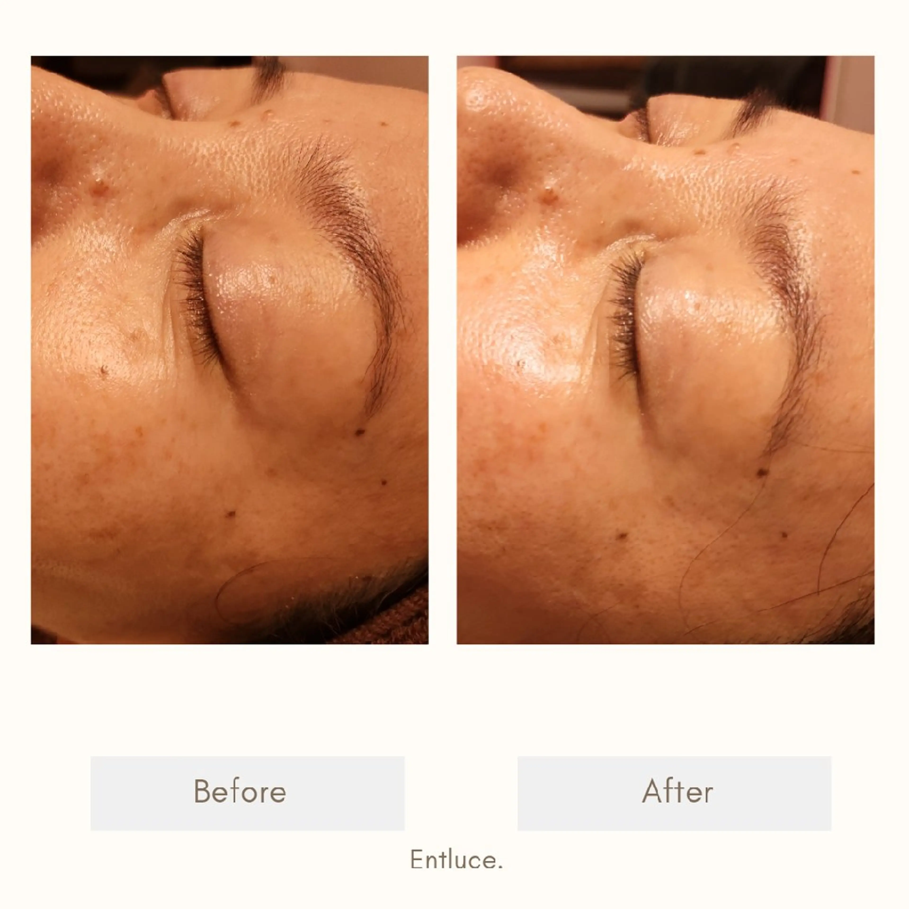 即効⚡小顔美容鍼🪡 むくみたるみ脂肪解消のエステ・リラクイメージ