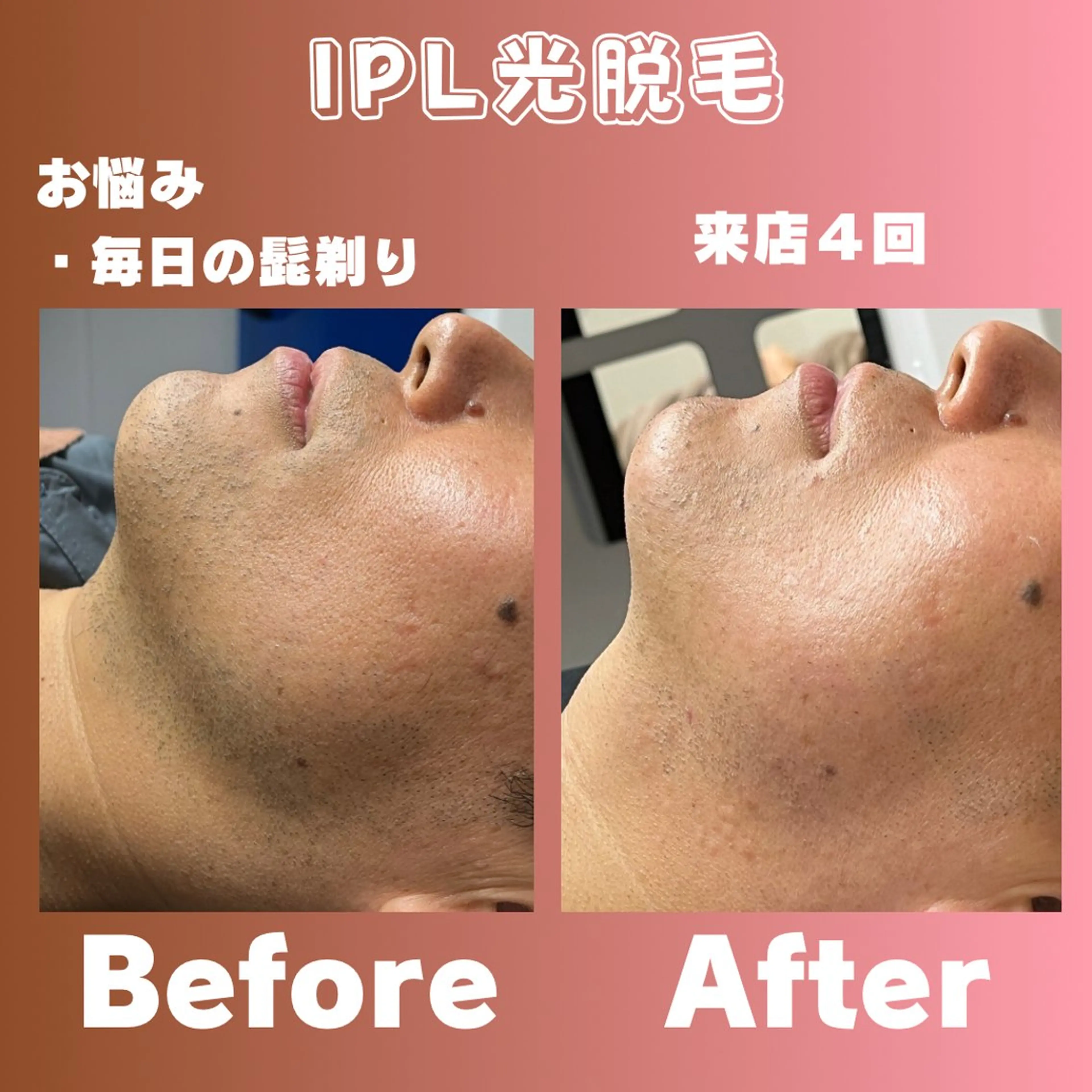 肌綺麗にメンズ髭脱毛★今年こそ髭剃り卒業👋熟練プロにしか出来ない見極め脱毛。適切なレベルで痛みが無いのに効果抜群の写真