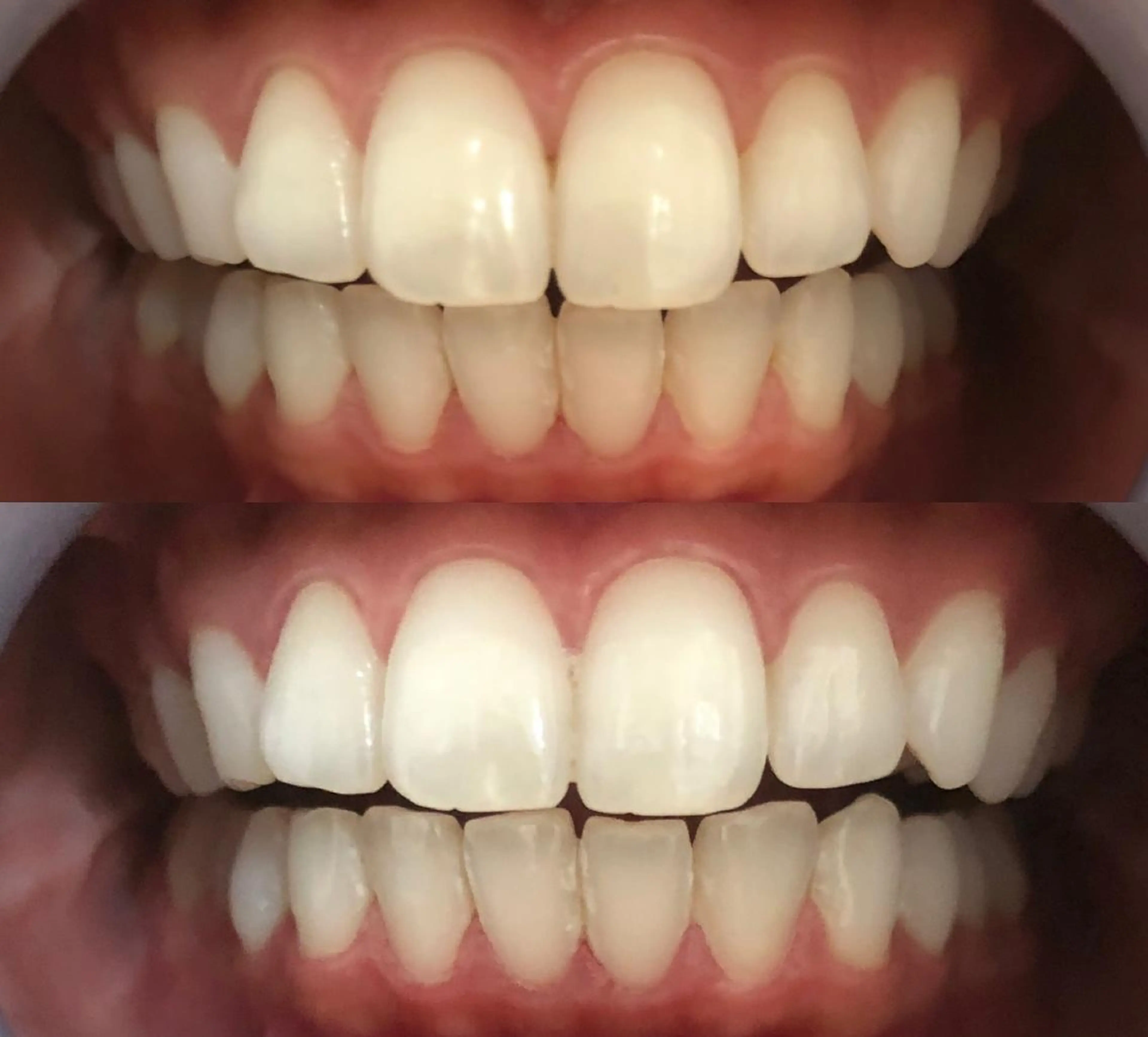 【2回目以降の方・都度払い🆗】8分照射×2回✨セルフホワイトニング🦷✨の写真