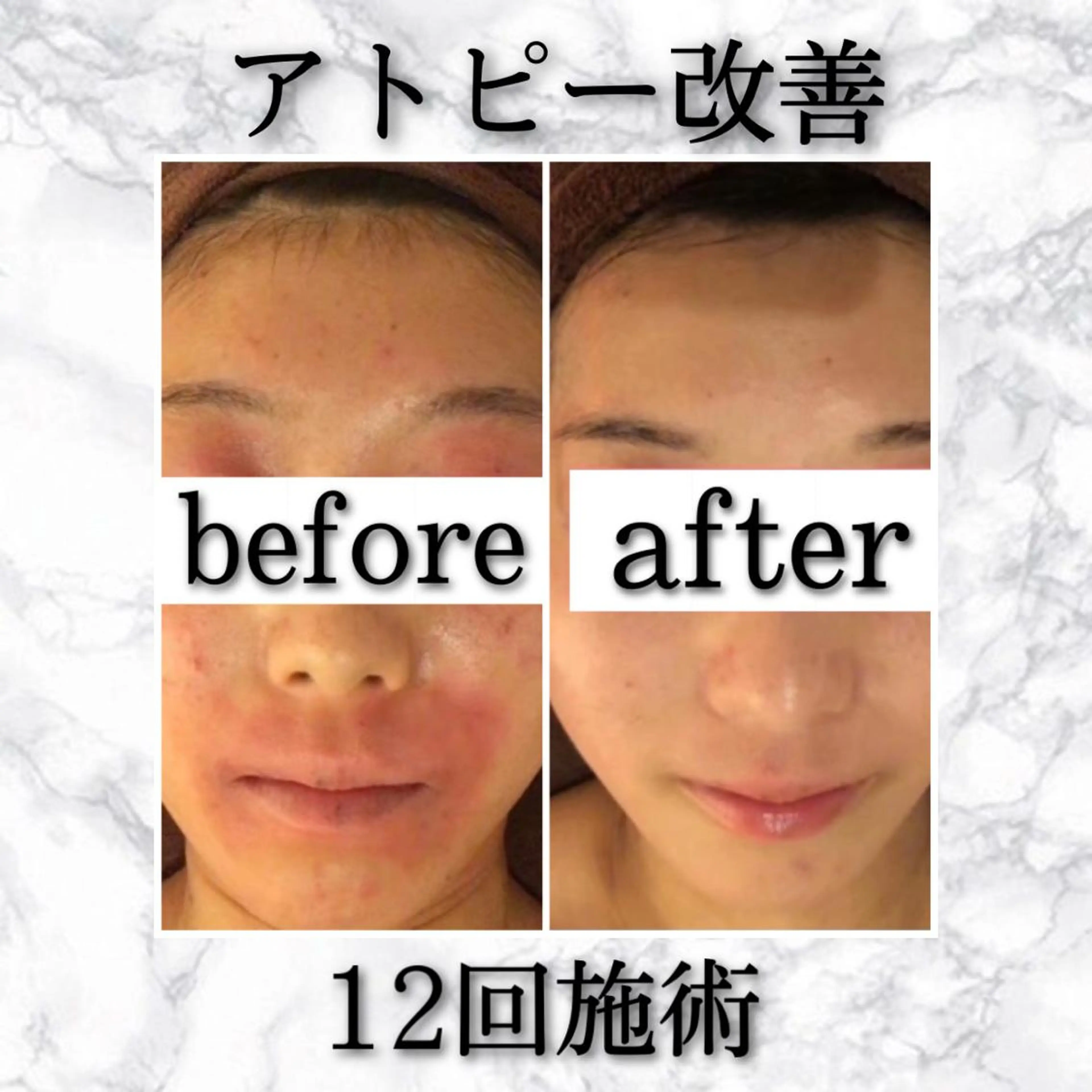 ロング カラー パーマ ヘアアレンジ メンズ キッズ ネイル マツエク・マツパ アイブロウ エステ リラク ニキビ特化型エステ 🍓最短で肌質改善のエステ・リラクイメージ