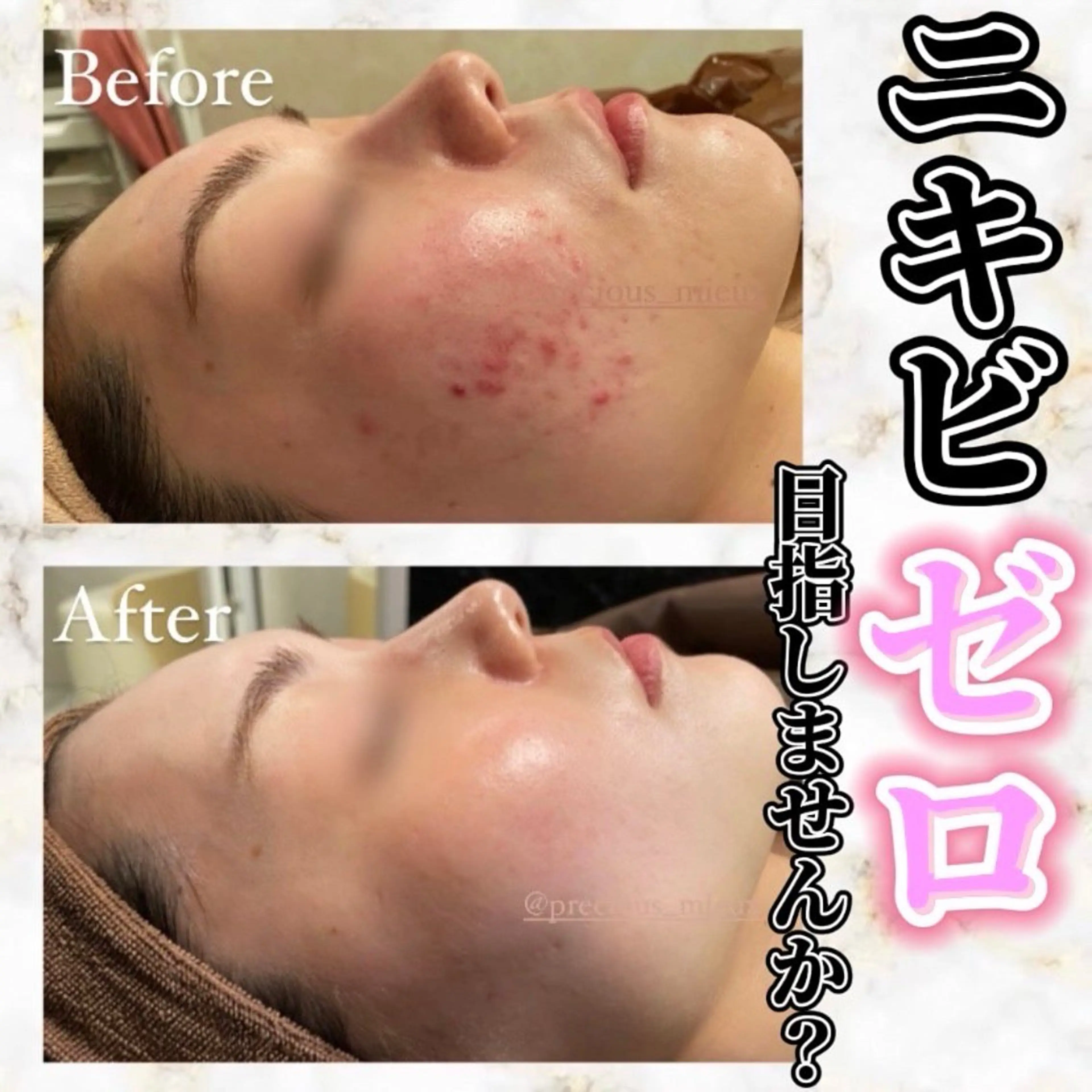 【どのメニューを選んだらいいかわからない方はこちら✋♥️】カウンセリング🎀お悩みに合わせご提案させていただきます😌の写真