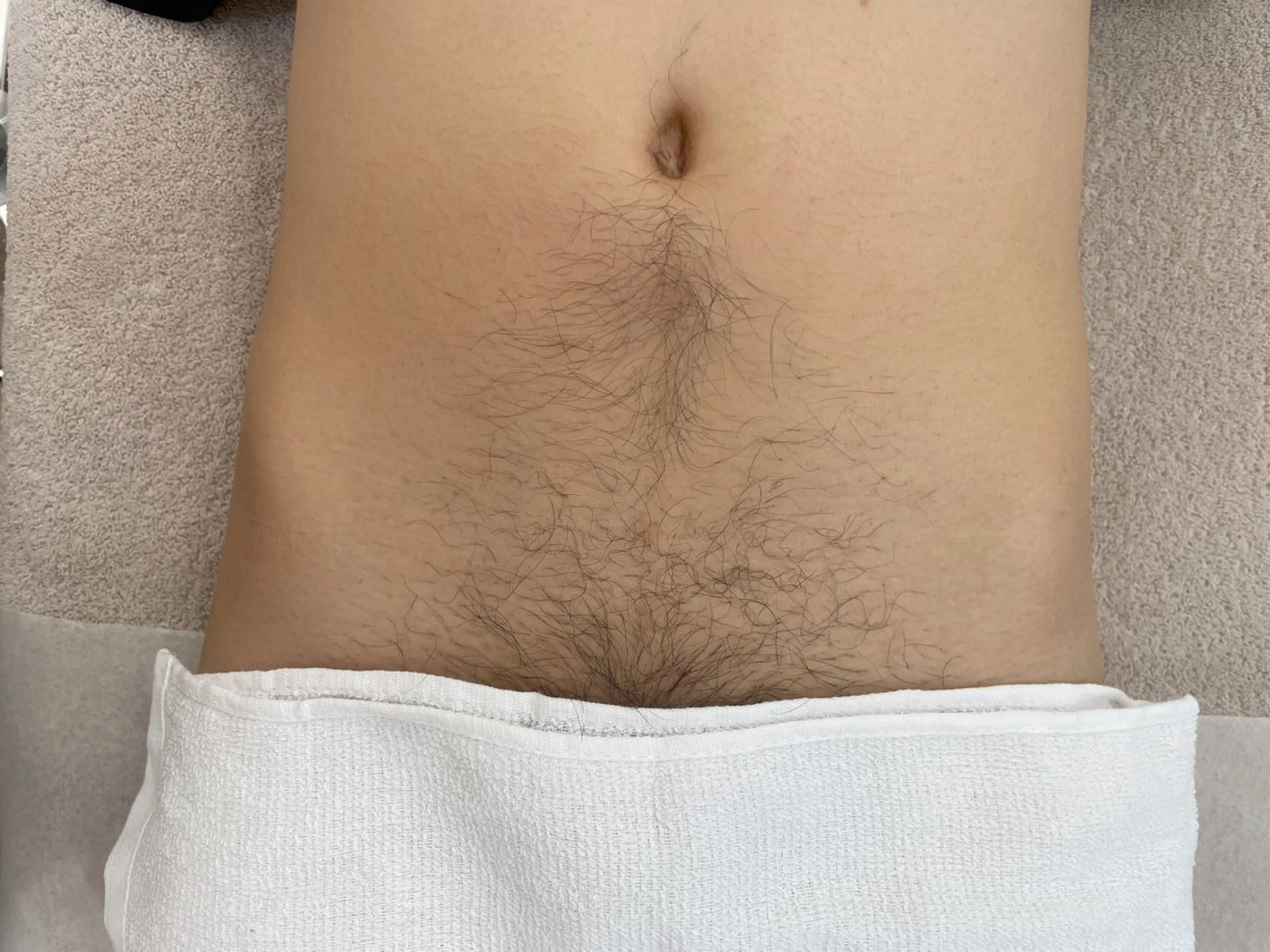 男性VIO【光脱毛】の写真