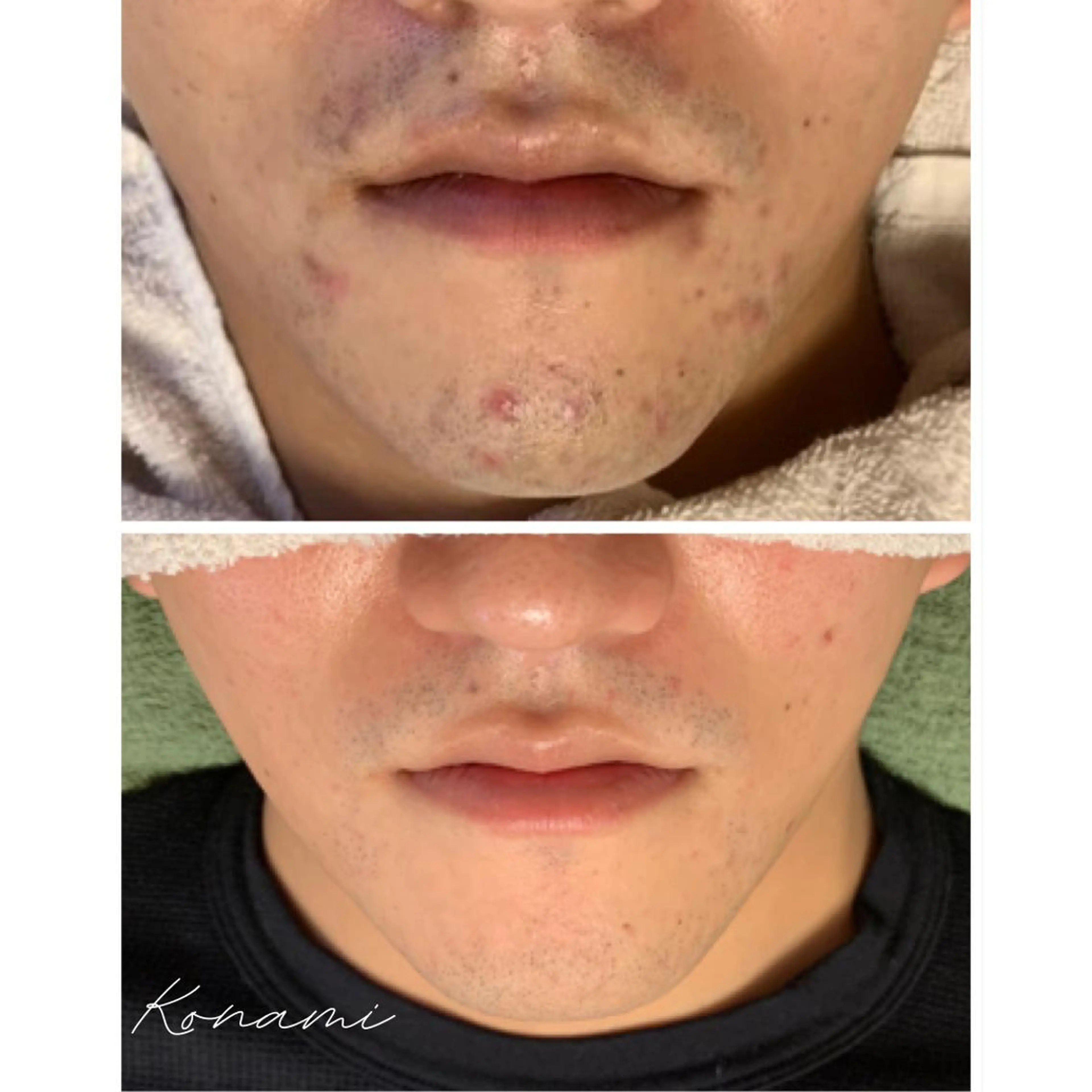 メンズ 脱毛 シードリン 府内店 小波のエステ・リラクイメージ