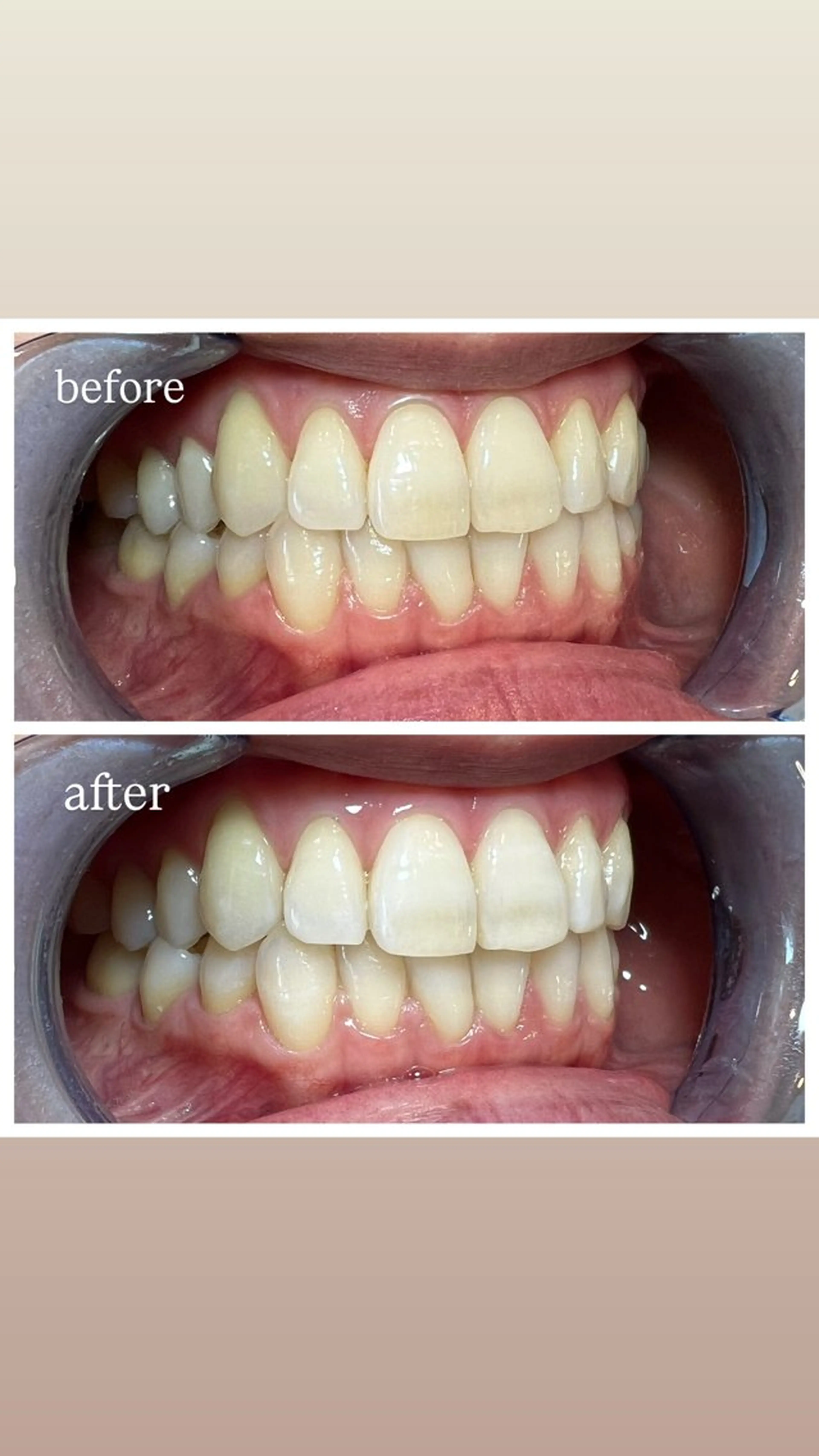 セルフホワイトニング Shineeのエステ・リラクイメージ