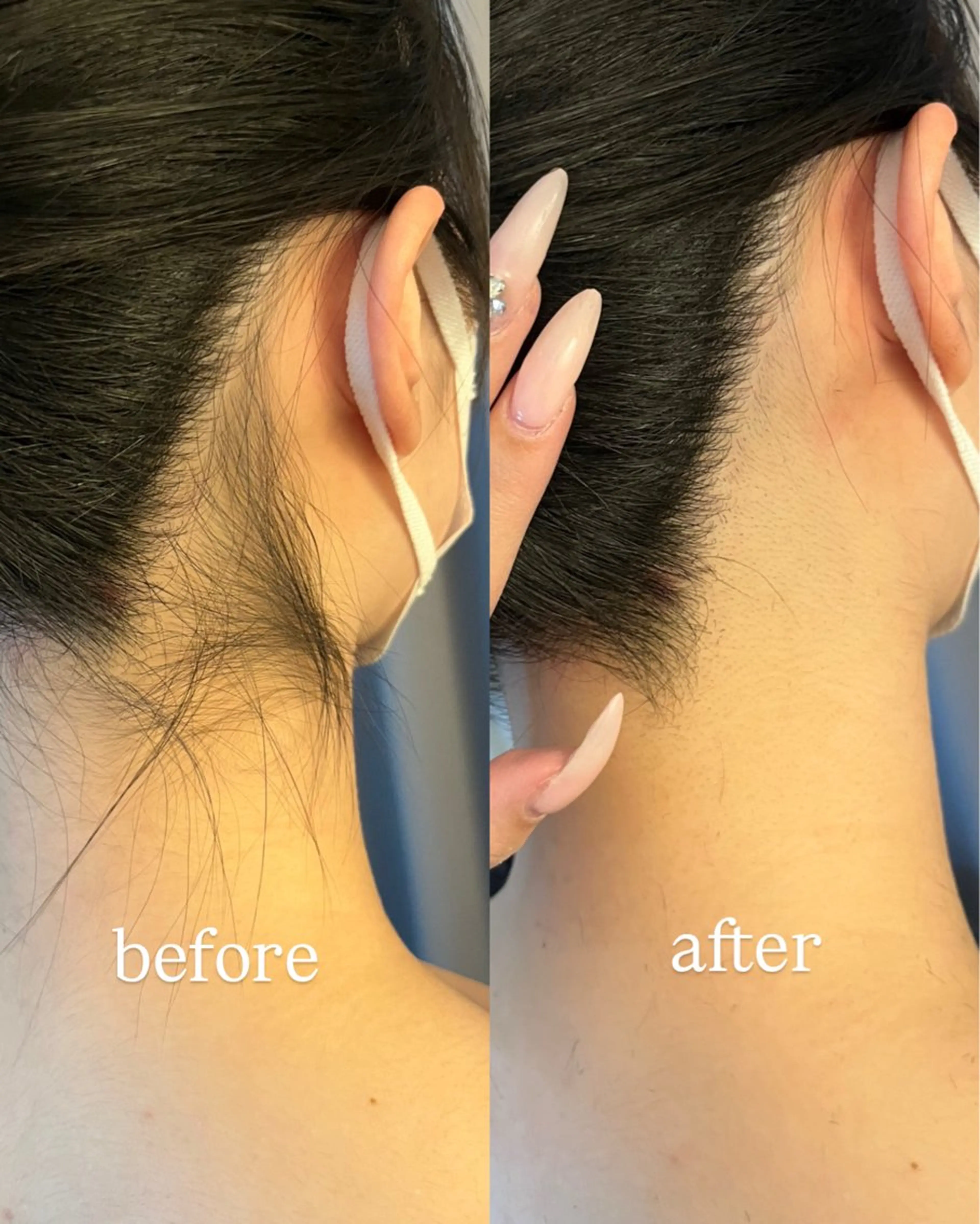 【成人式の方限定✨】うなじ脱毛二回チケット(シェービング付き)/お得にうなじを脱毛しよう※今年成人式の方限定の写真