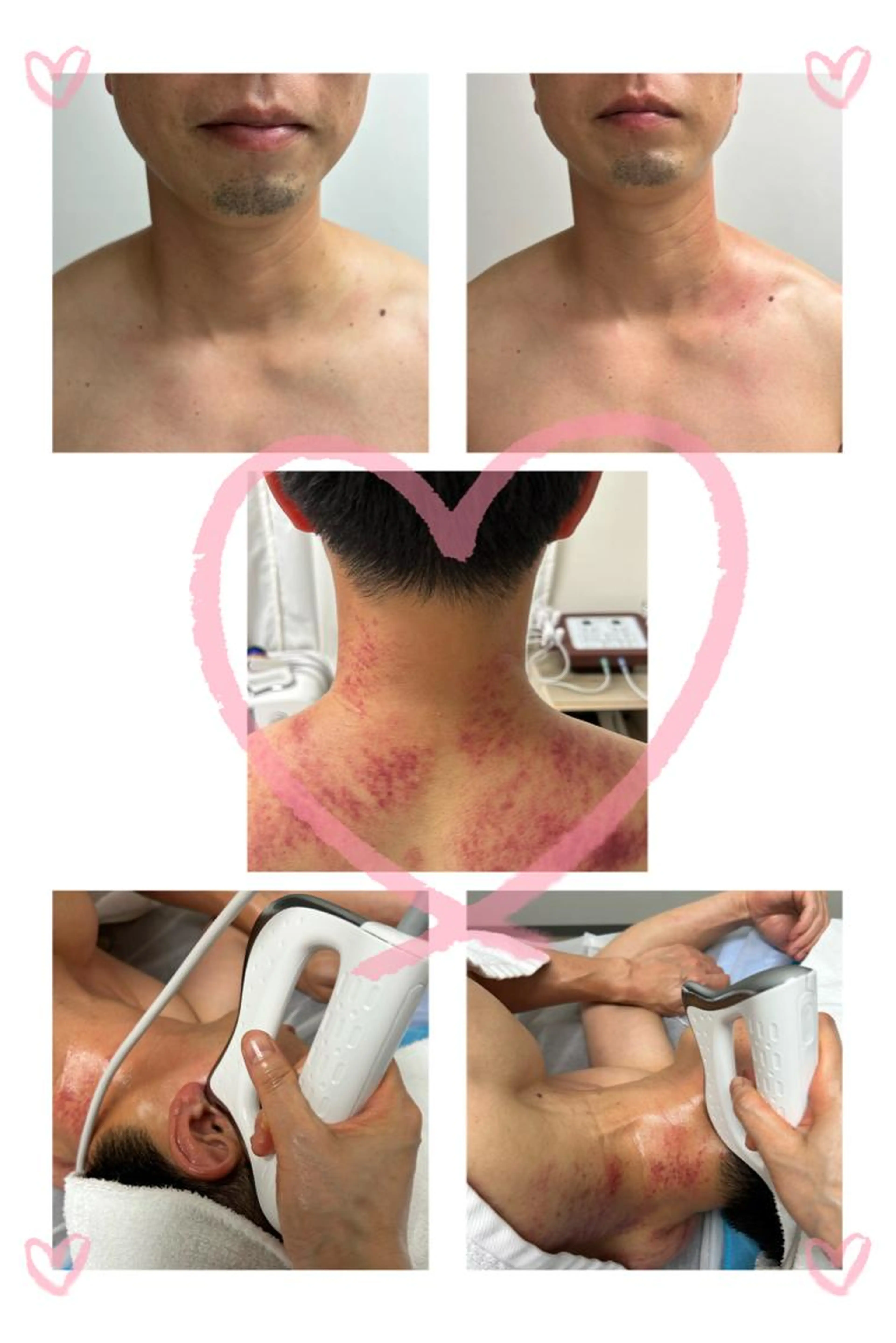 最新［BIOEMS筋膜リリース+ハンドリンパ］肩こり、首、腰、みくみ⭐️上半身to下半身選べるの写真