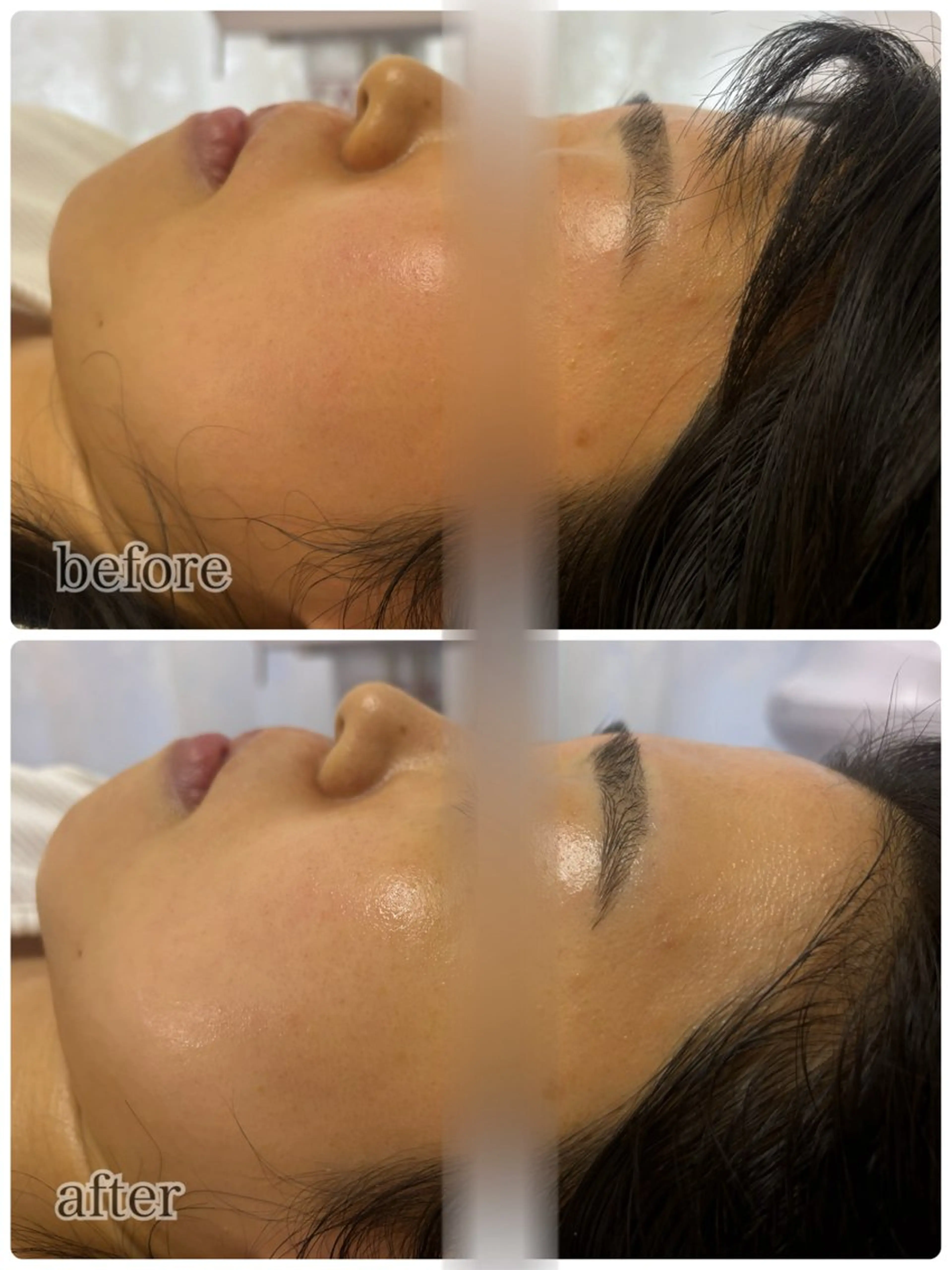 💎小顔スペシャルケア💎【脂肪撃退美容液導入×リフトアップ1パーツ】1回で効果実感の声ありの写真