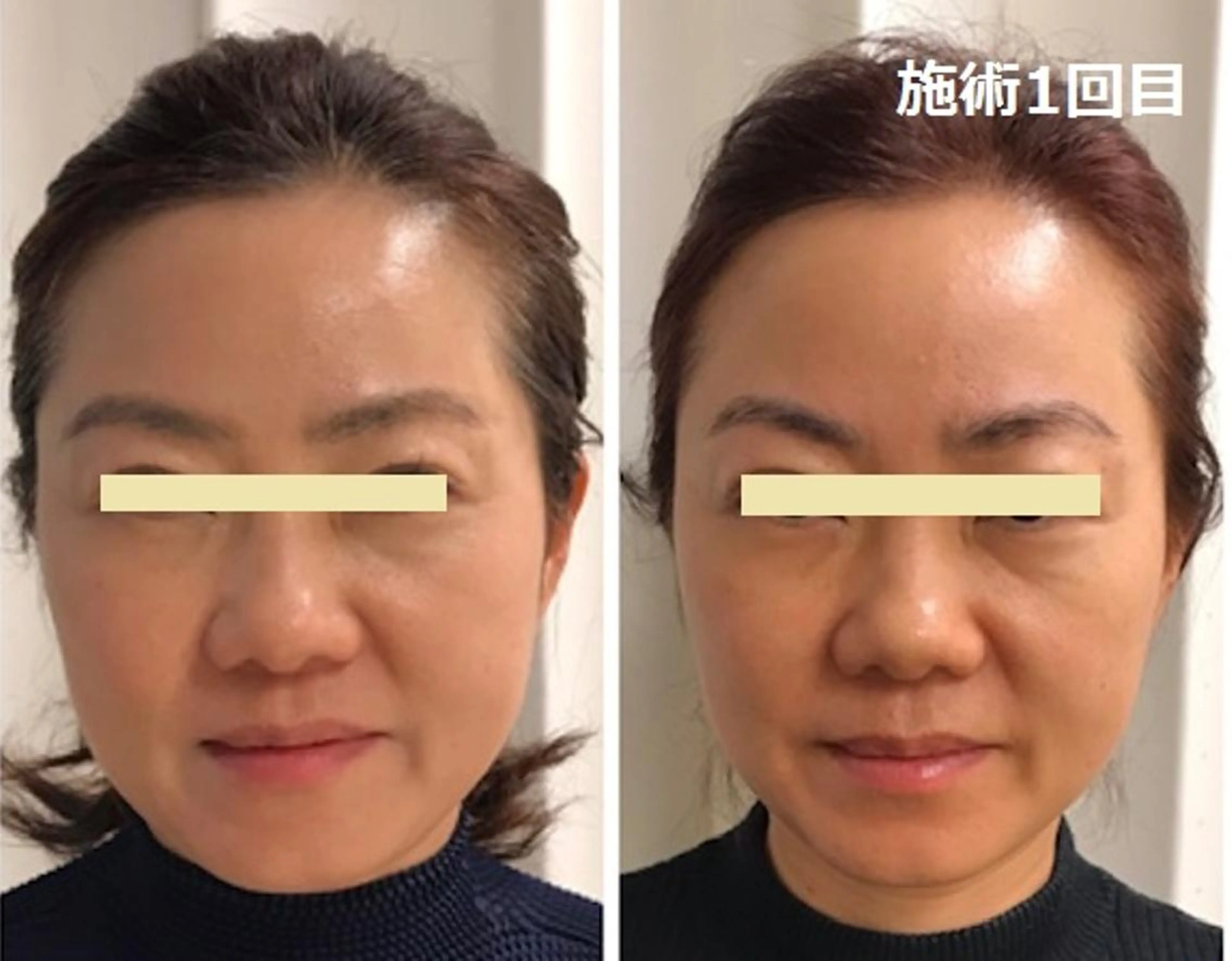 エステ 顔脱毛＆毛穴＆ニキビ 優良№1♪ヒロコ♪のエステ・リラクイメージ