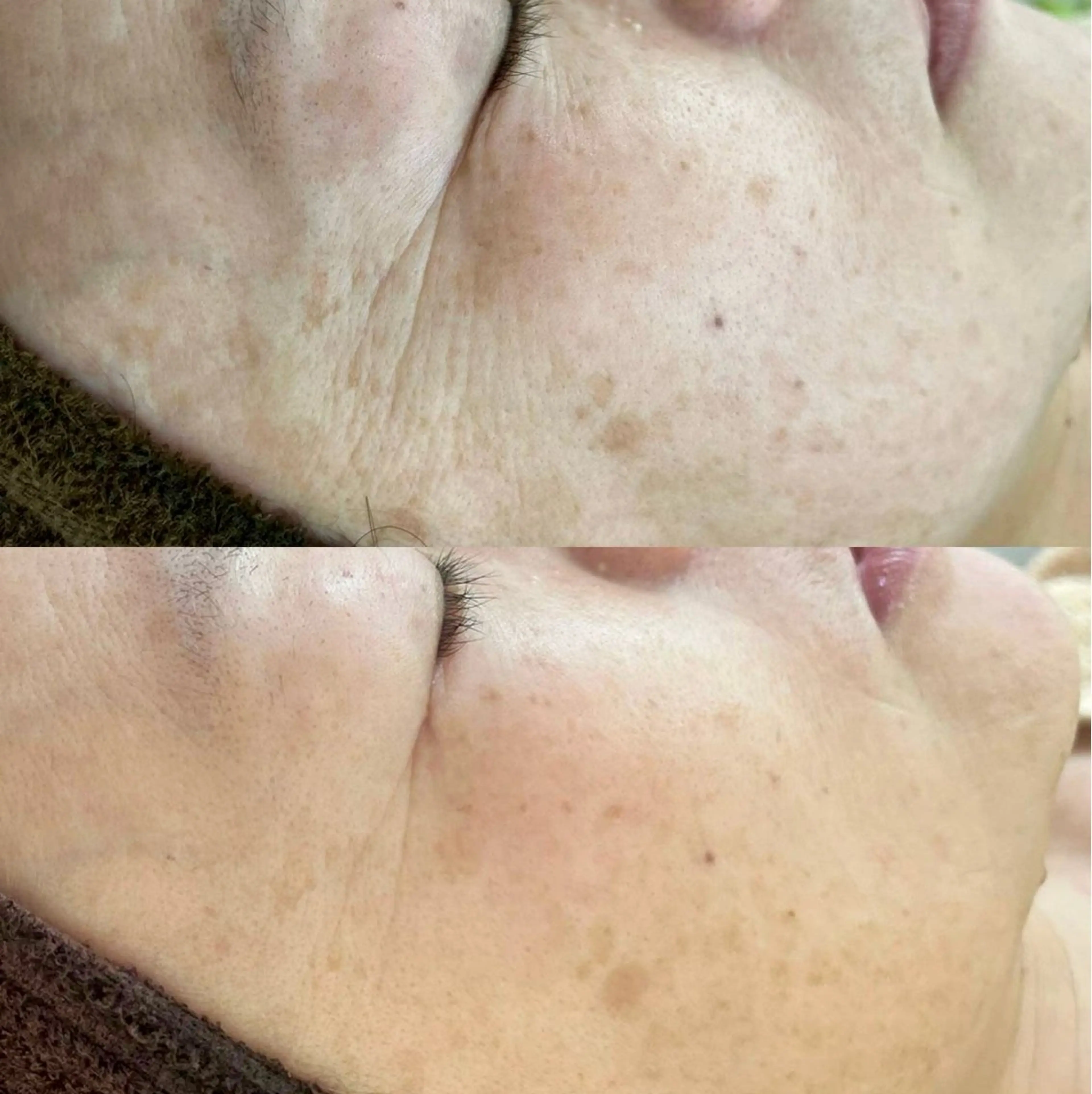 【最上級メニューがしたい❗️】ハーブピーリング🌿フルオプション陶肌トリートメント✨の写真