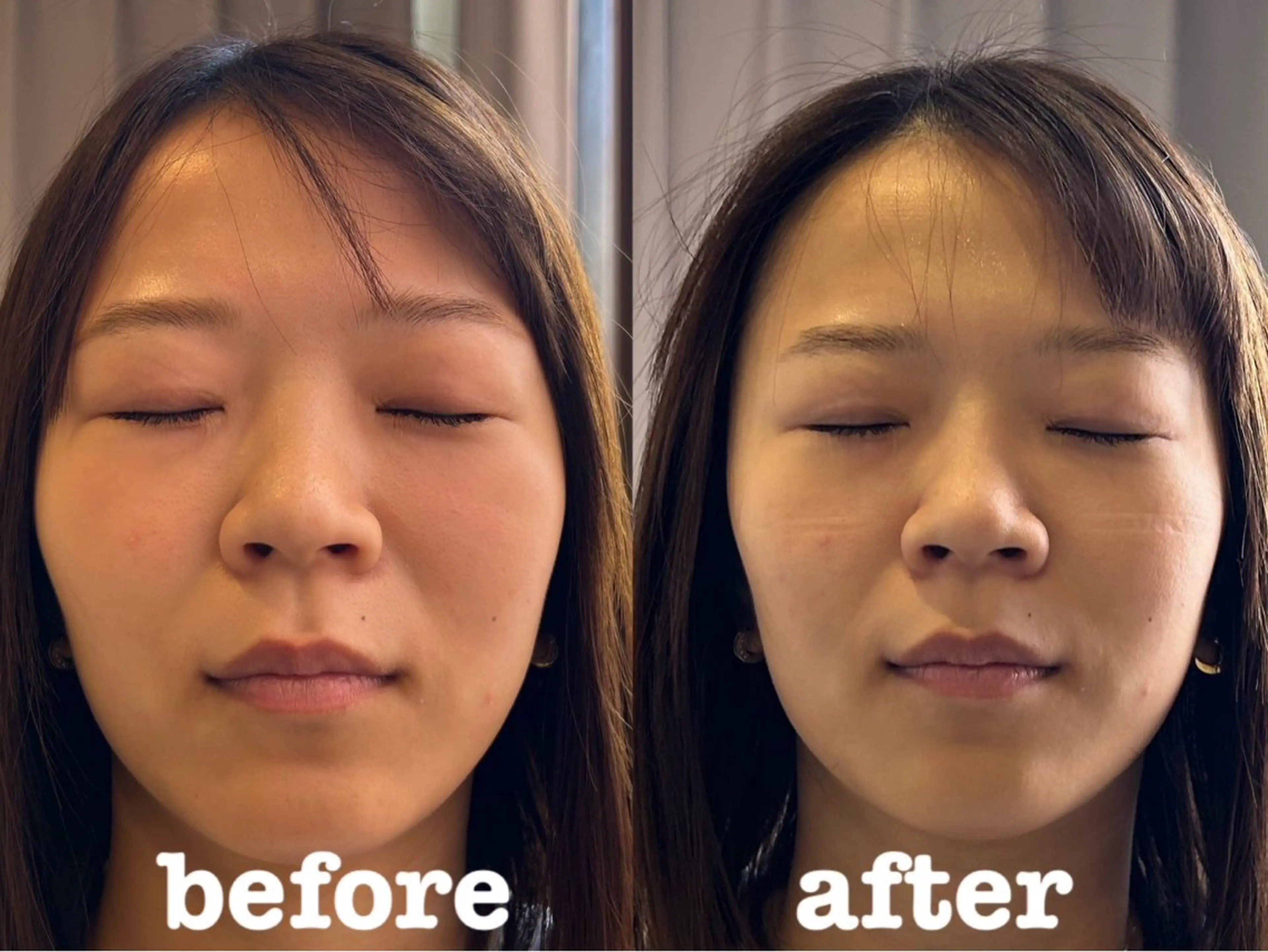 エステ リラク 美容鍼灸Solana所属・肌質改善×美容鍼 ゆいのエステ・リラクイメージ