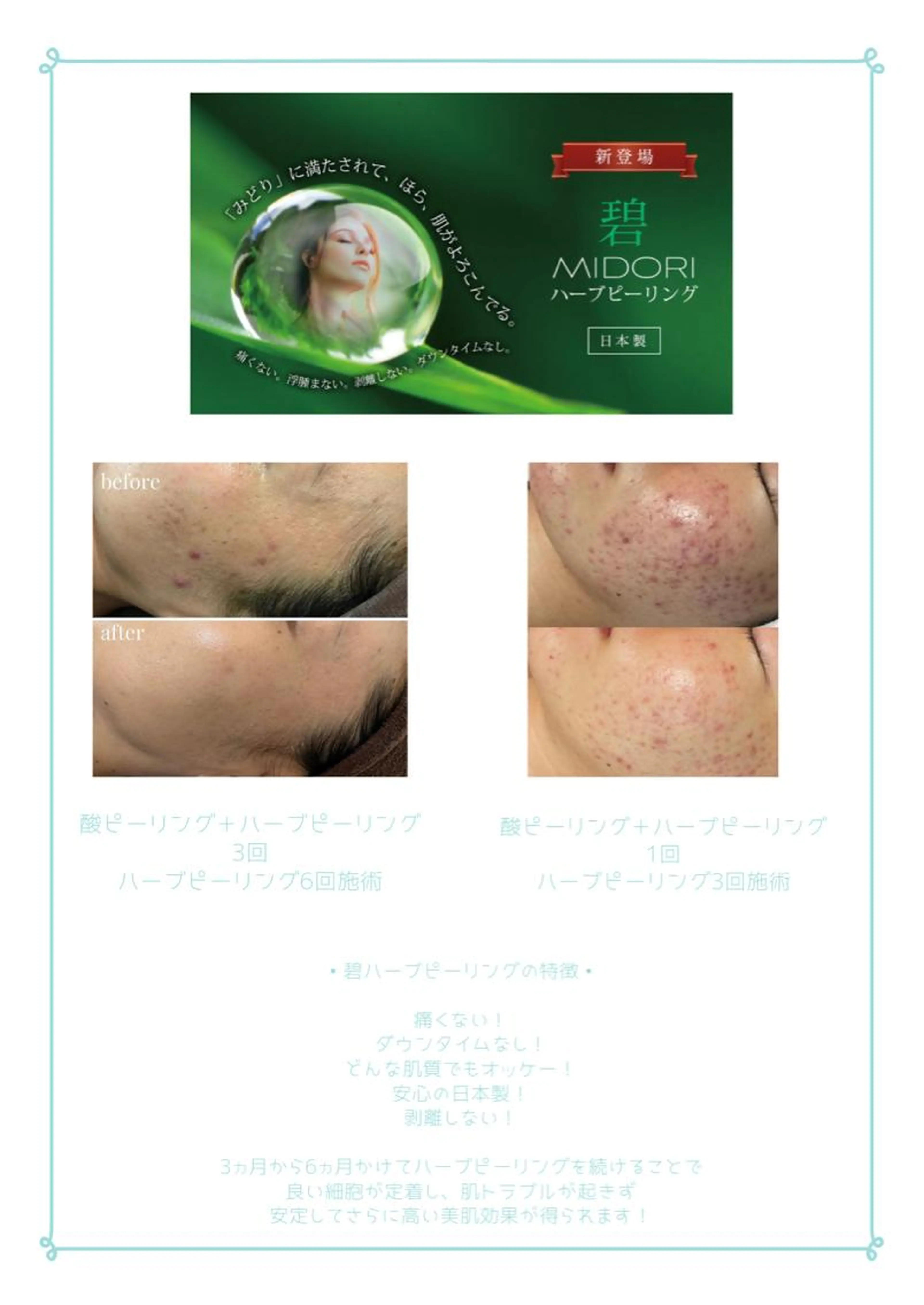 ハーブピーリング🌿5回コースモニター価格❣️の写真