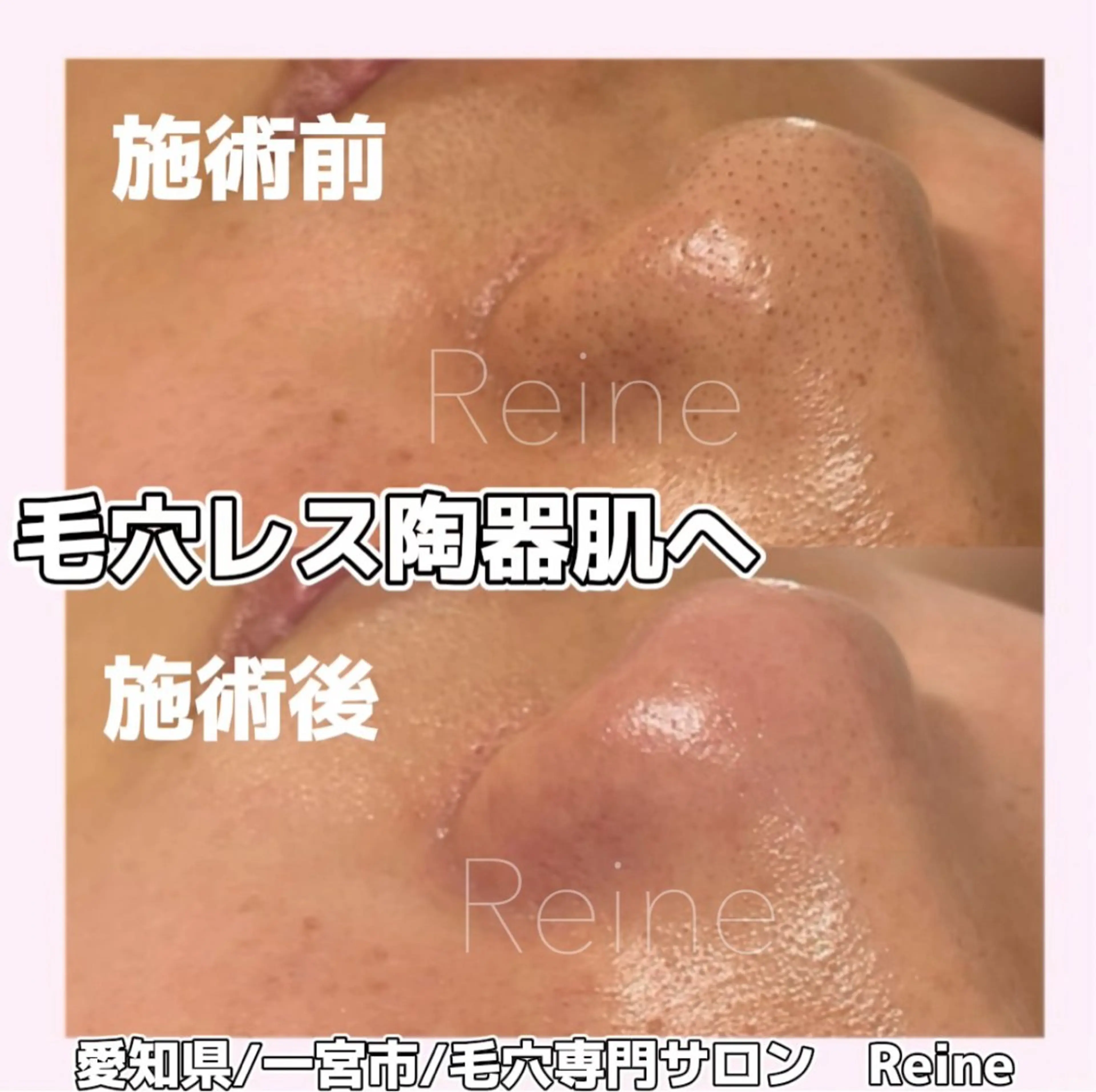 エステ Reine BeautySalon所属・毛穴/シミ肝斑/脱毛 横山梨里のエステ・リラクイメージ