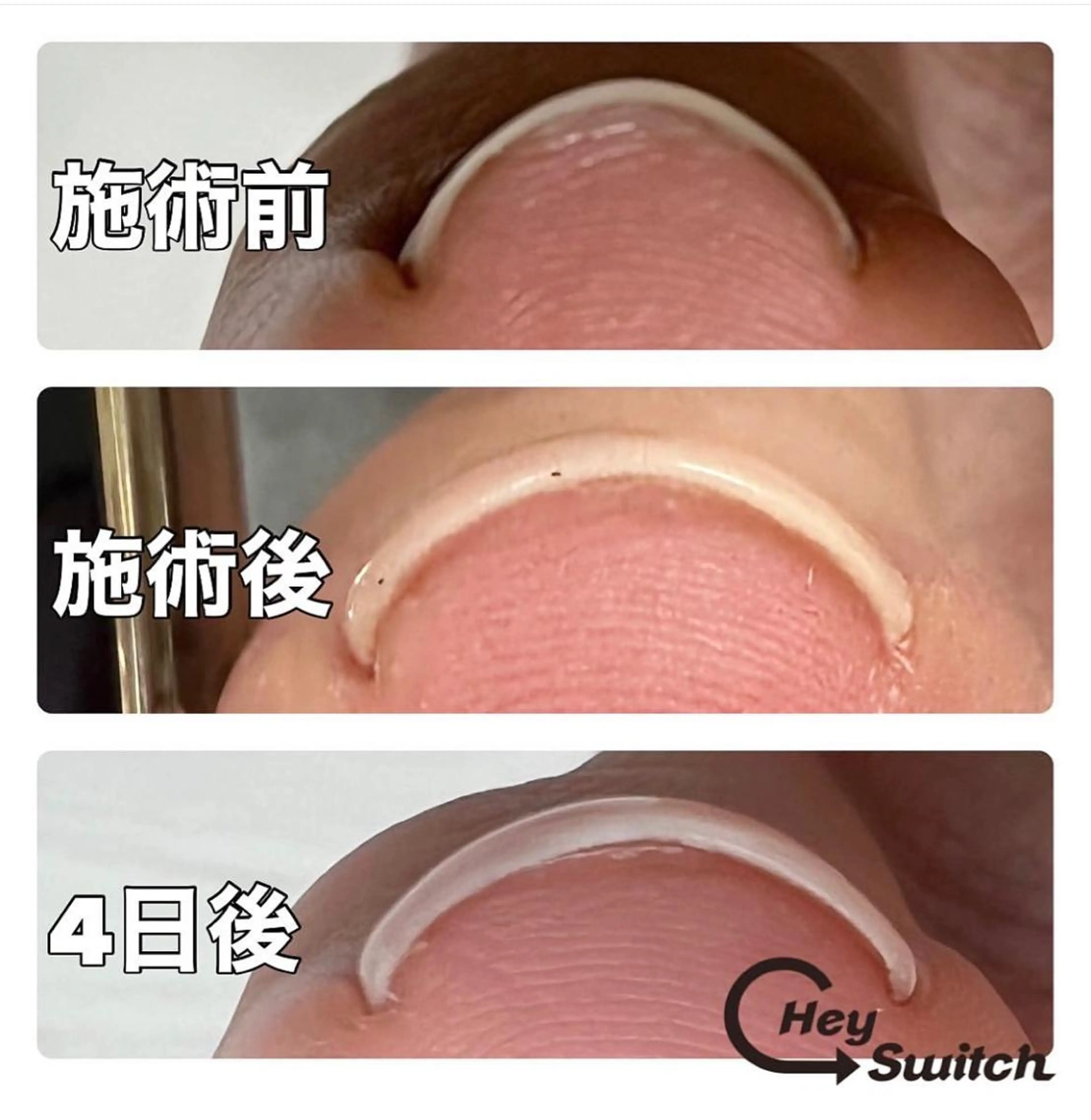 🇰🇷韓国より初上陸✨今話題の巻き爪ケア🦶ヘイスイッチ取り扱い店✨の写真