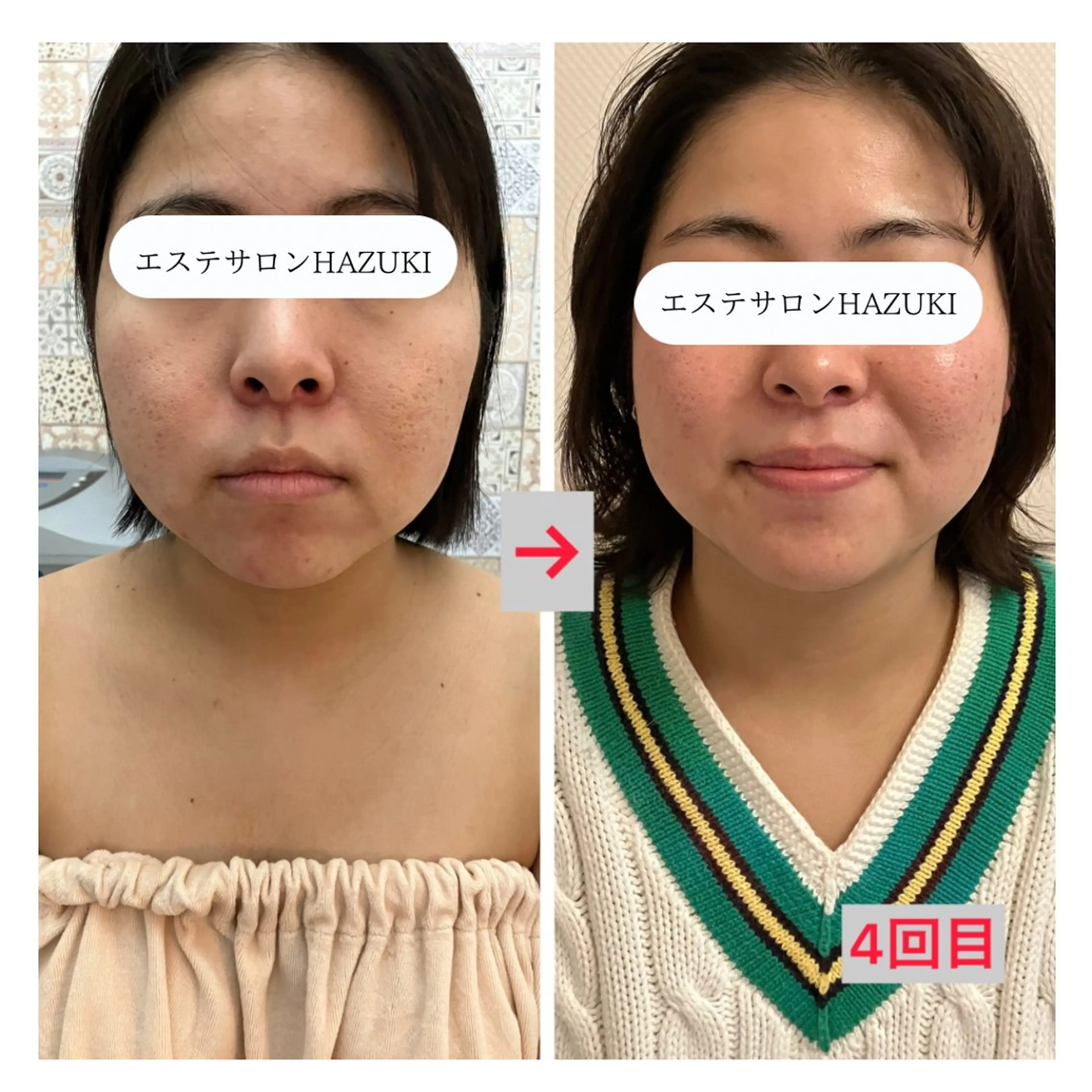 その他 たるみ改善小顔エステ 堀葉月のその他イメージ