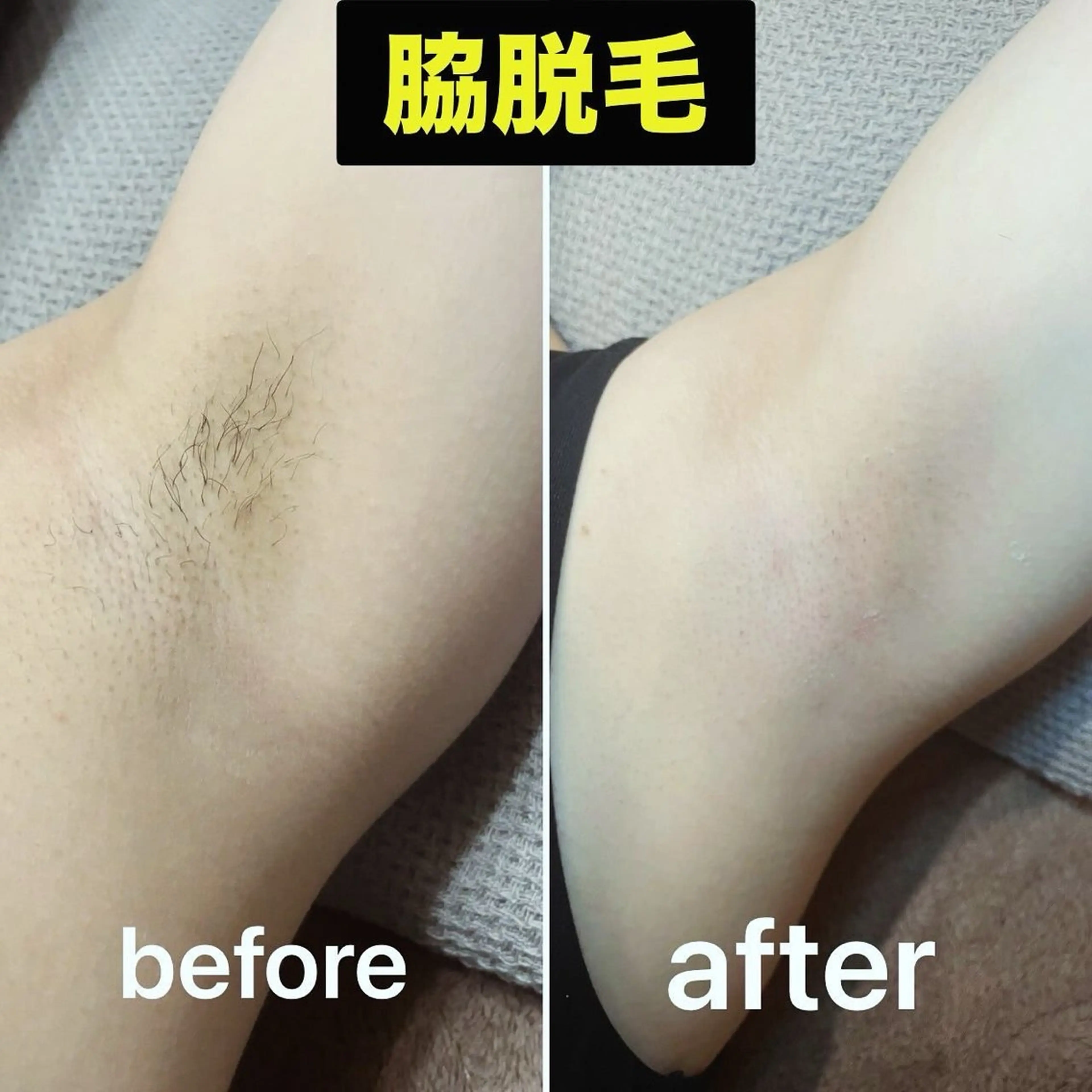 両脇ワックス脱毛‼️の写真