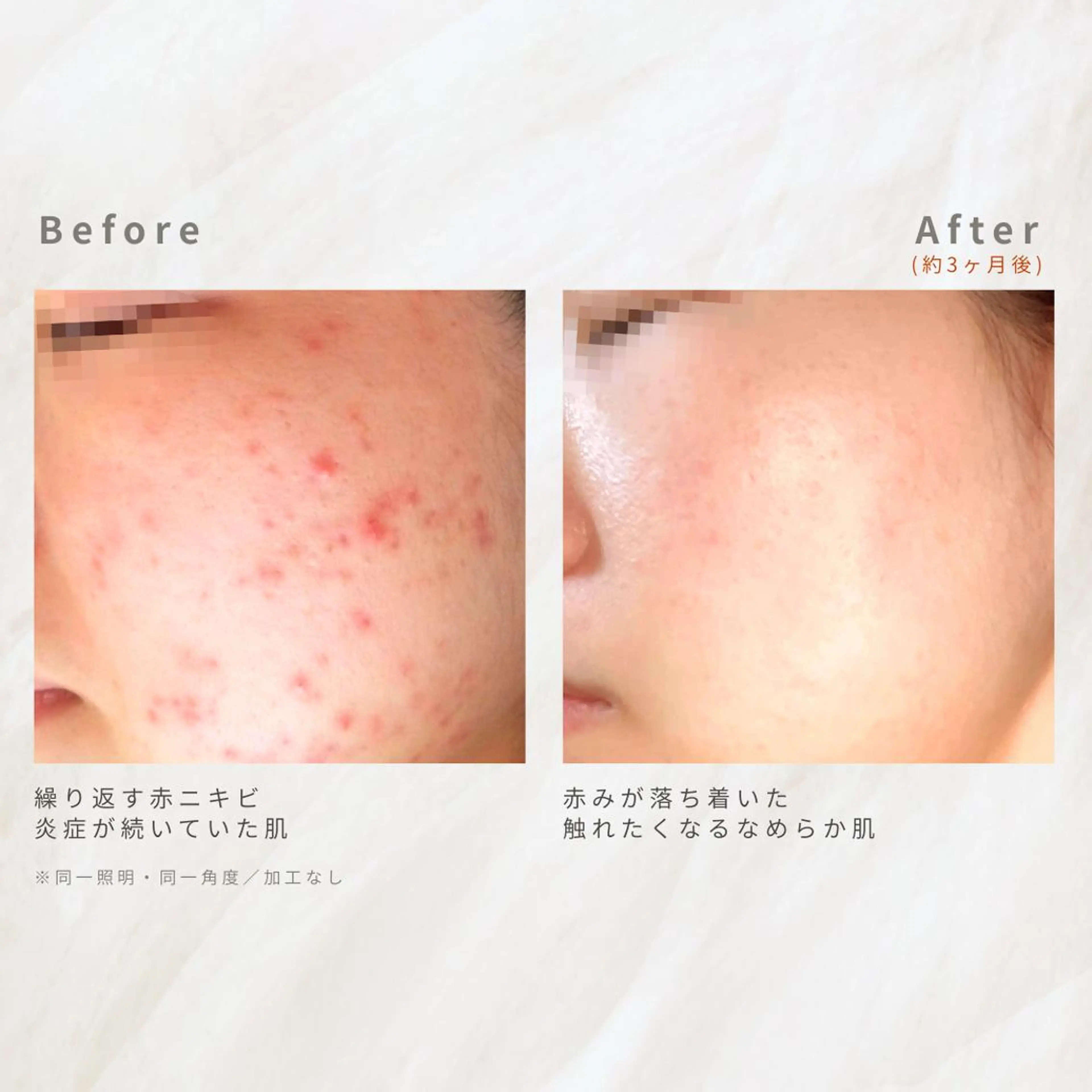 繰り返すニキビを改善 ✨つくば肌質改善専門のエステ・リラクイメージ