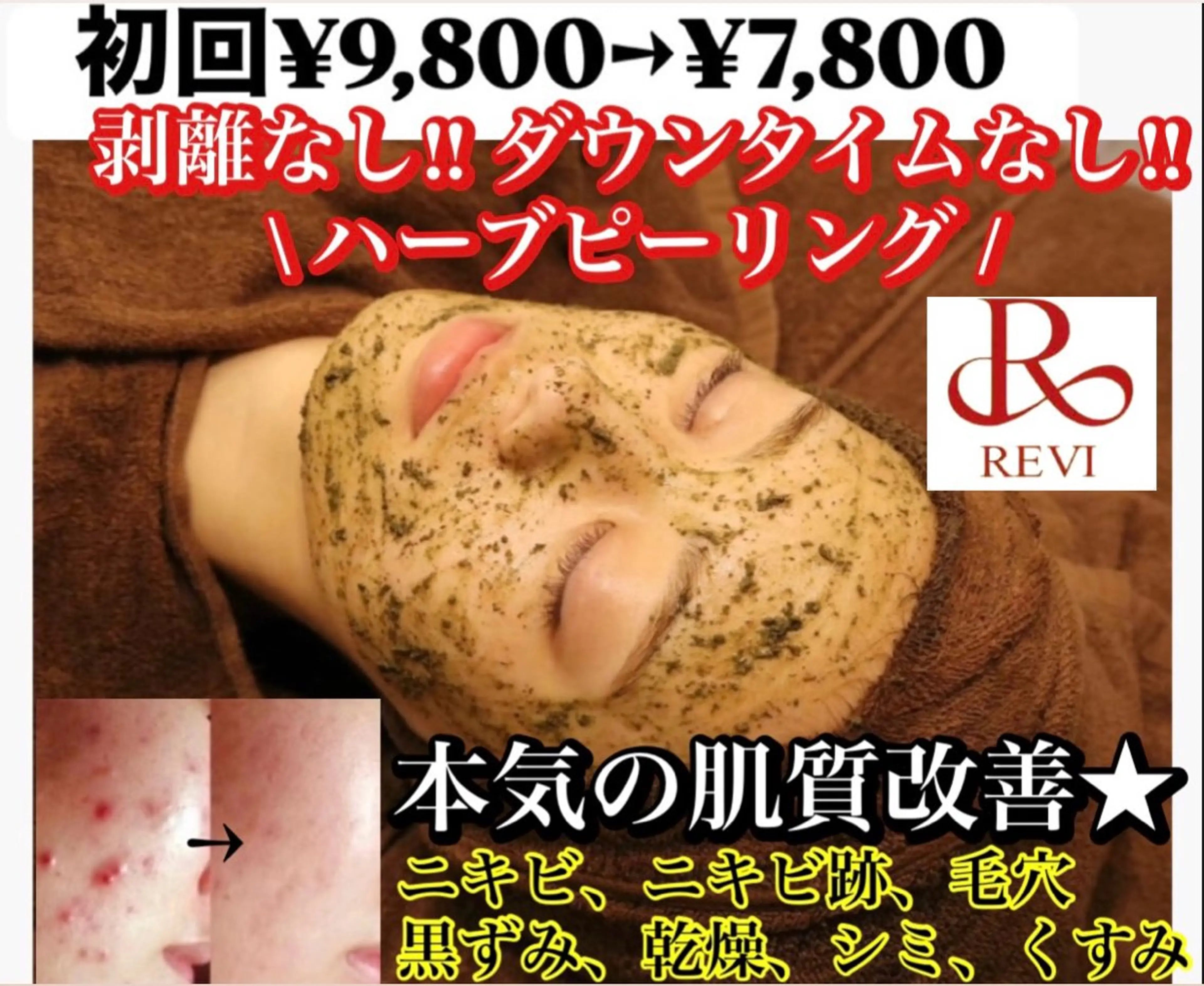 【ニキビケア・トラブル肌改善】 REVI ハーブピーリング ¥9,800→¥7,800の写真