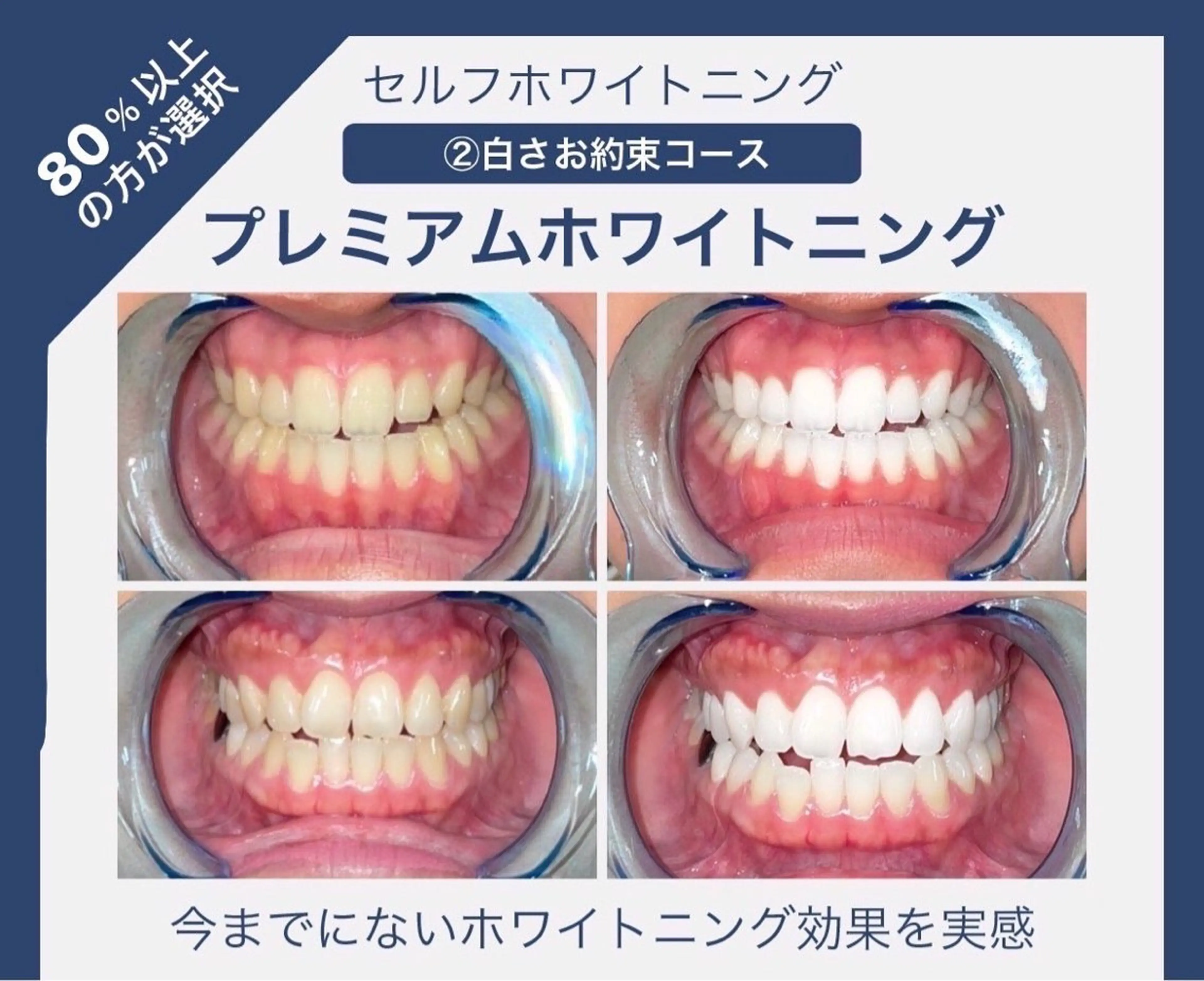 【8割以上の方が選択】プレミアムセルフホワイトニング❣️（2来店計70分照射）の写真