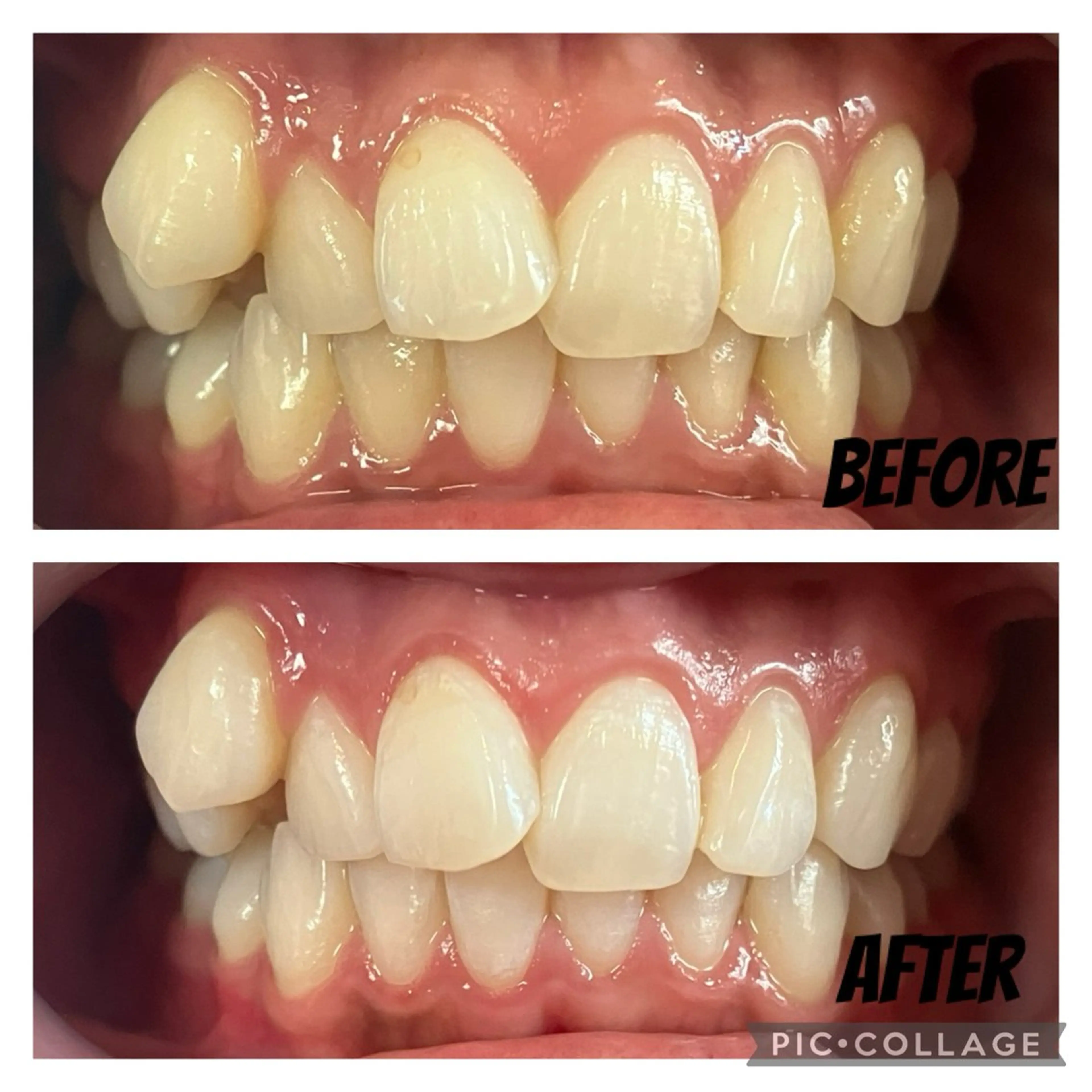 セルフホワイトニングSpecial（8mini✖️3照射）の写真