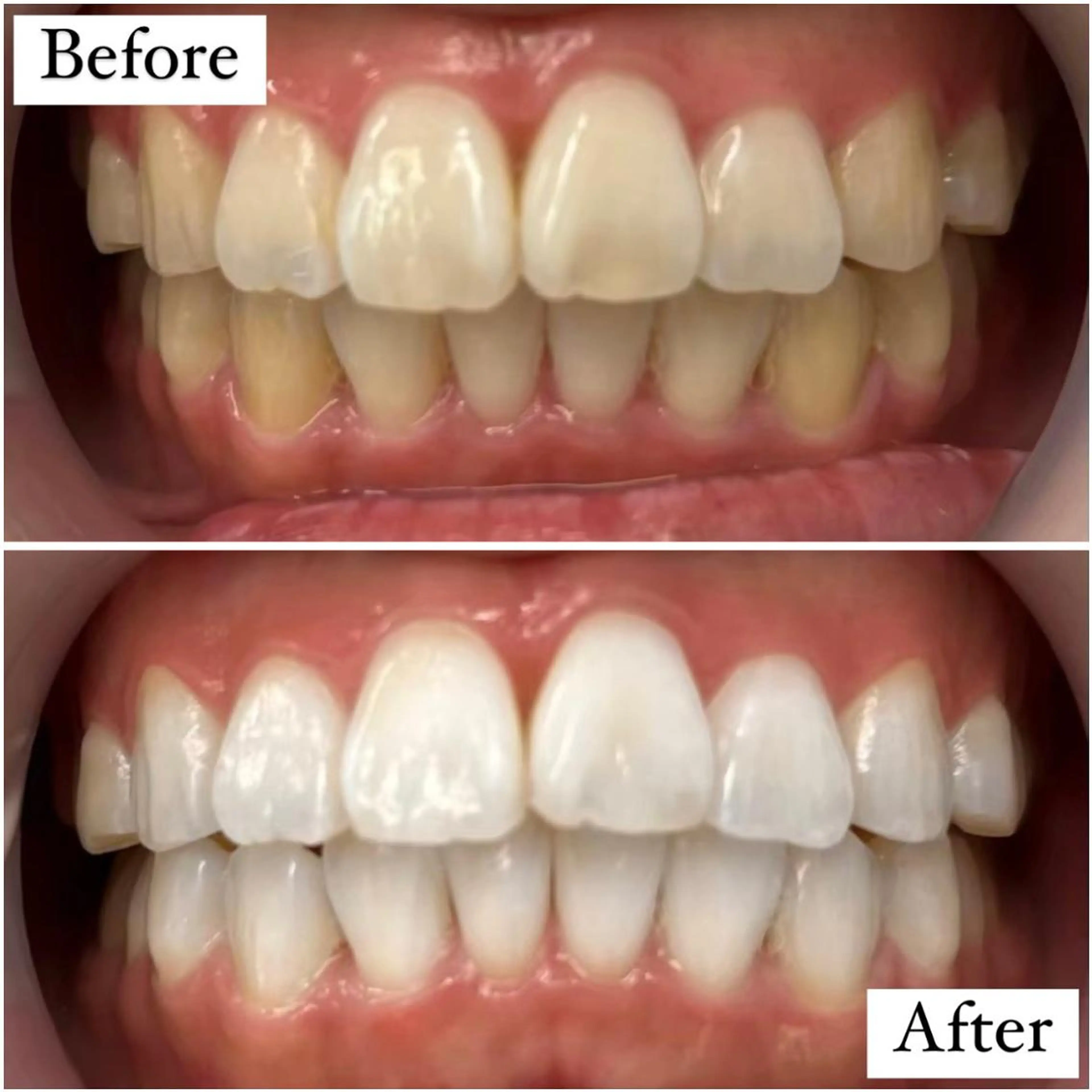 【本気で白い歯にしたい方へ✨】8分照射×4回❣️続けていきたい方には大人気のセルフホワイトニング🦷✨の写真