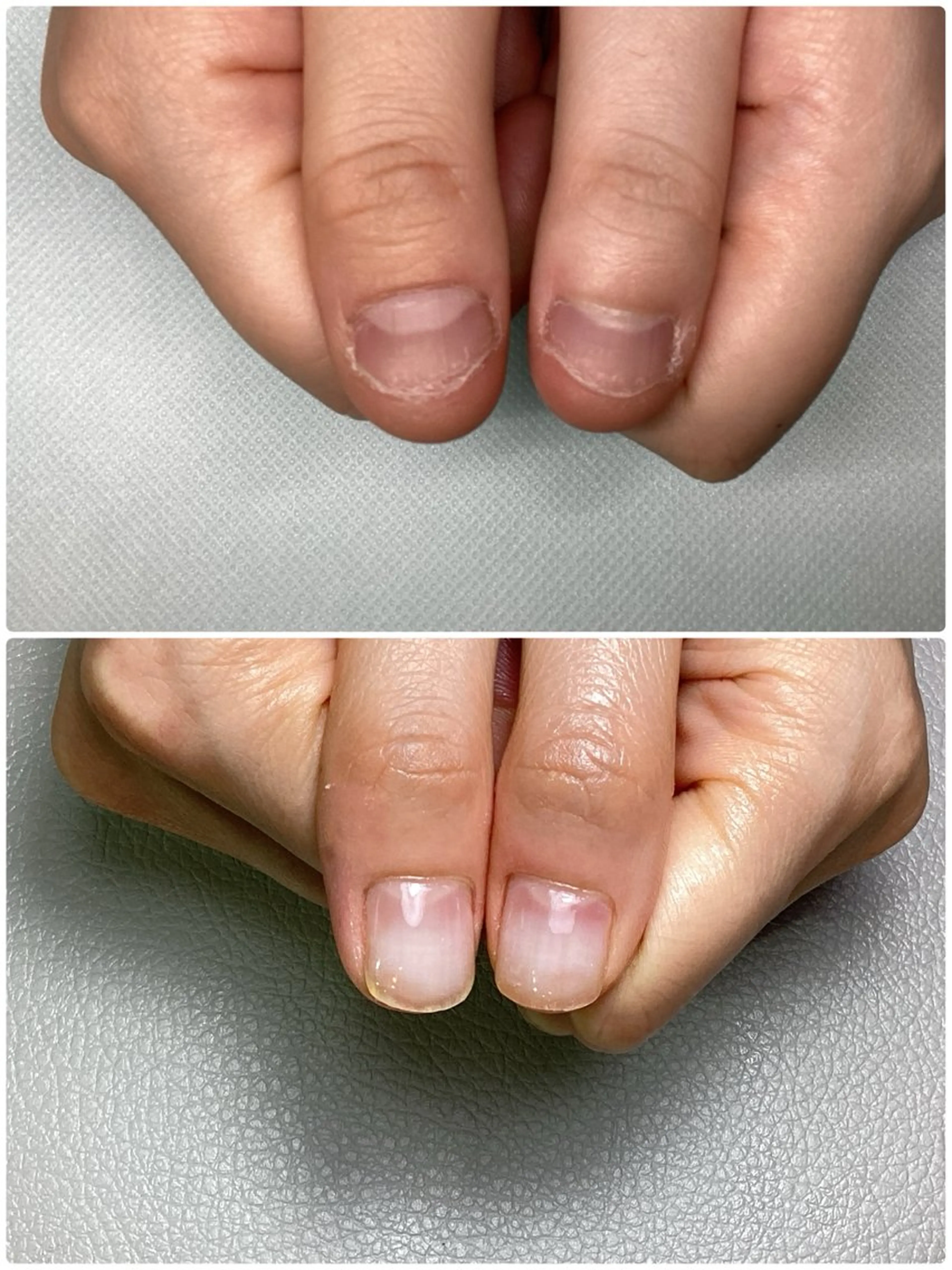 【深爪育成】深爪　噛み爪　爪悩みレディースの写真