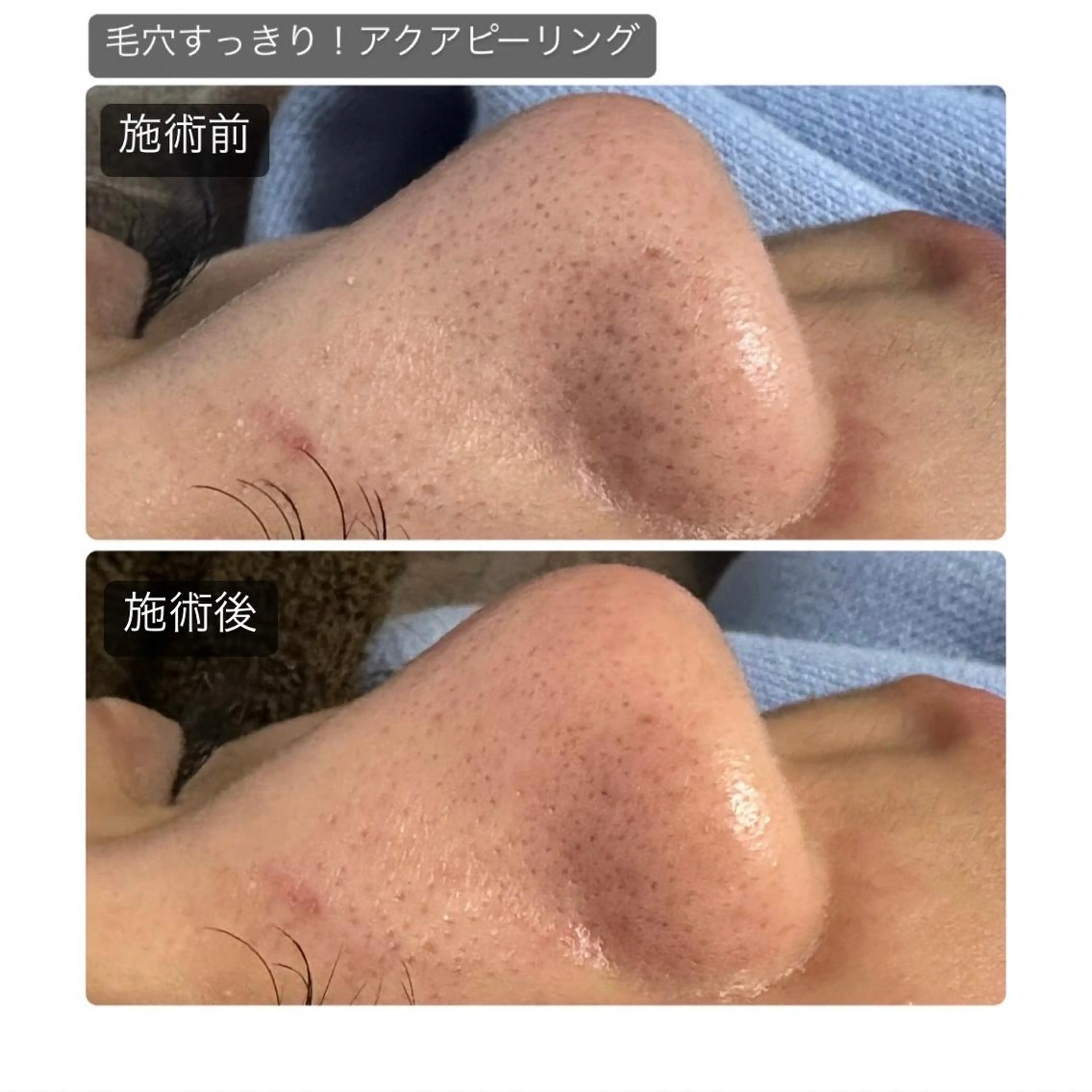 【毛穴詰まり】毛穴洗浄+ドライヘッドスパデコルテコース60分¥6800の写真