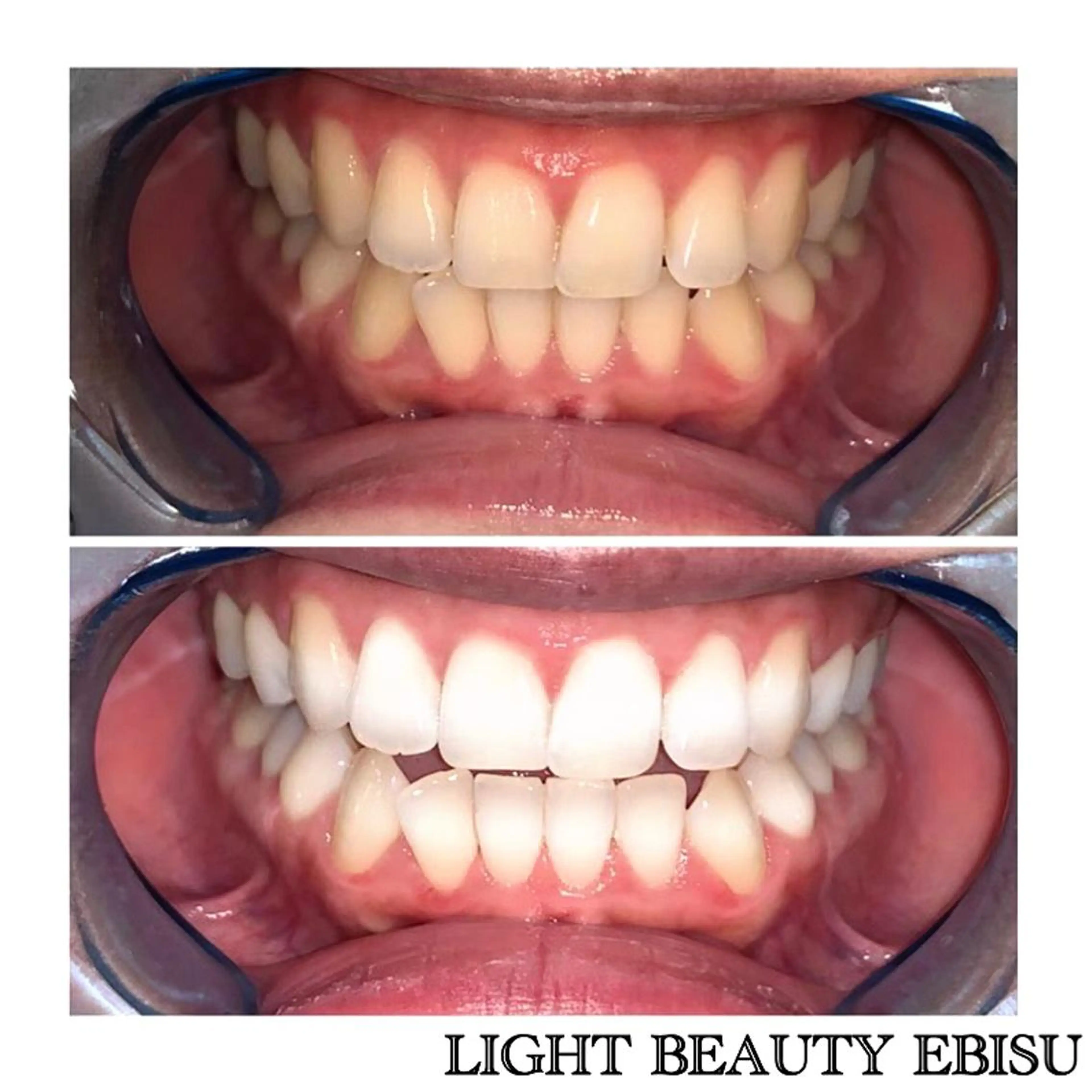 【白さを極める】真っ白お約束･ プレミアムホワイトニング❣〈合計 70分2 来店〉❣の写真