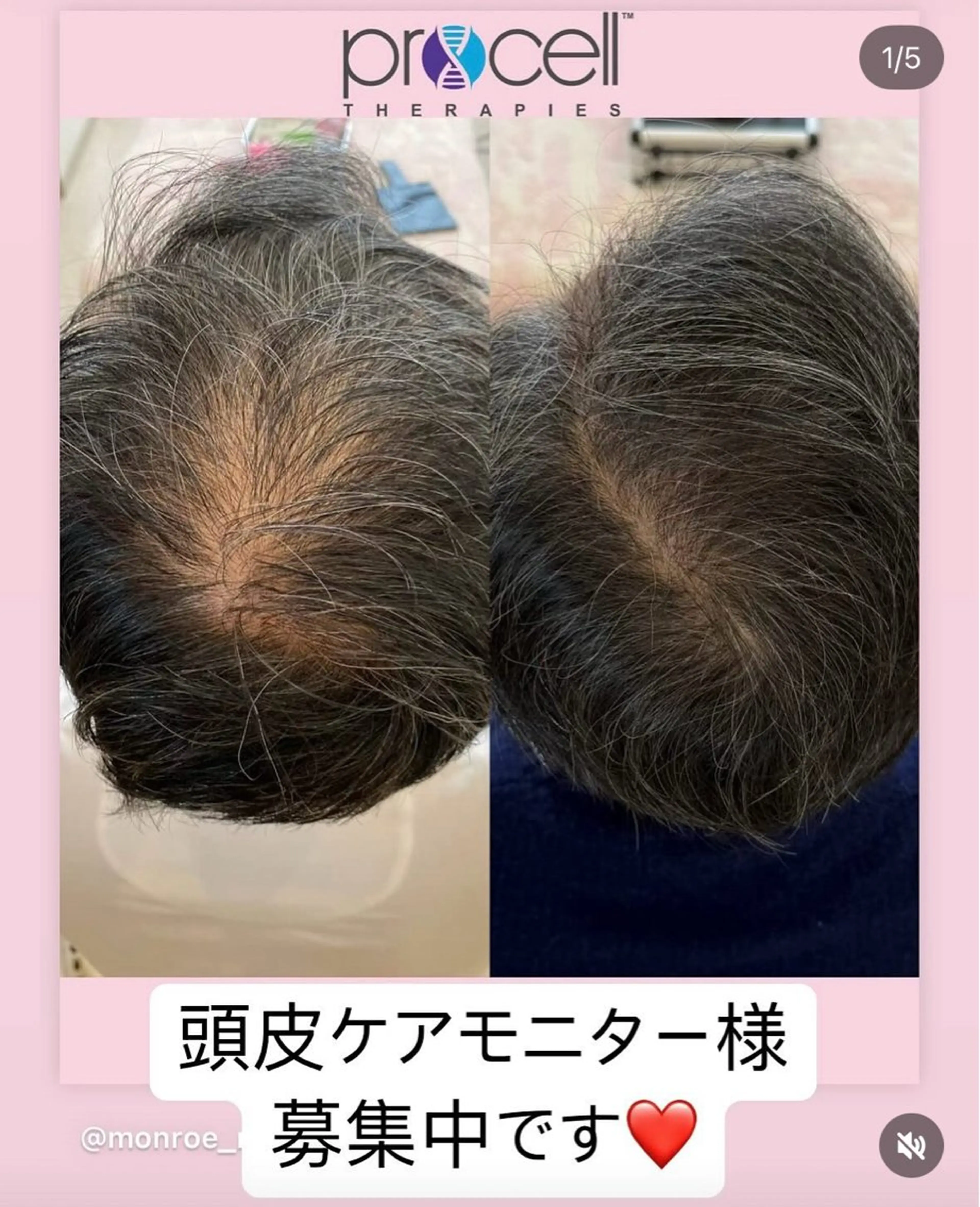 【毎月３名様限定】本気の頭皮改善ケア ¥47,000→¥40,000の写真