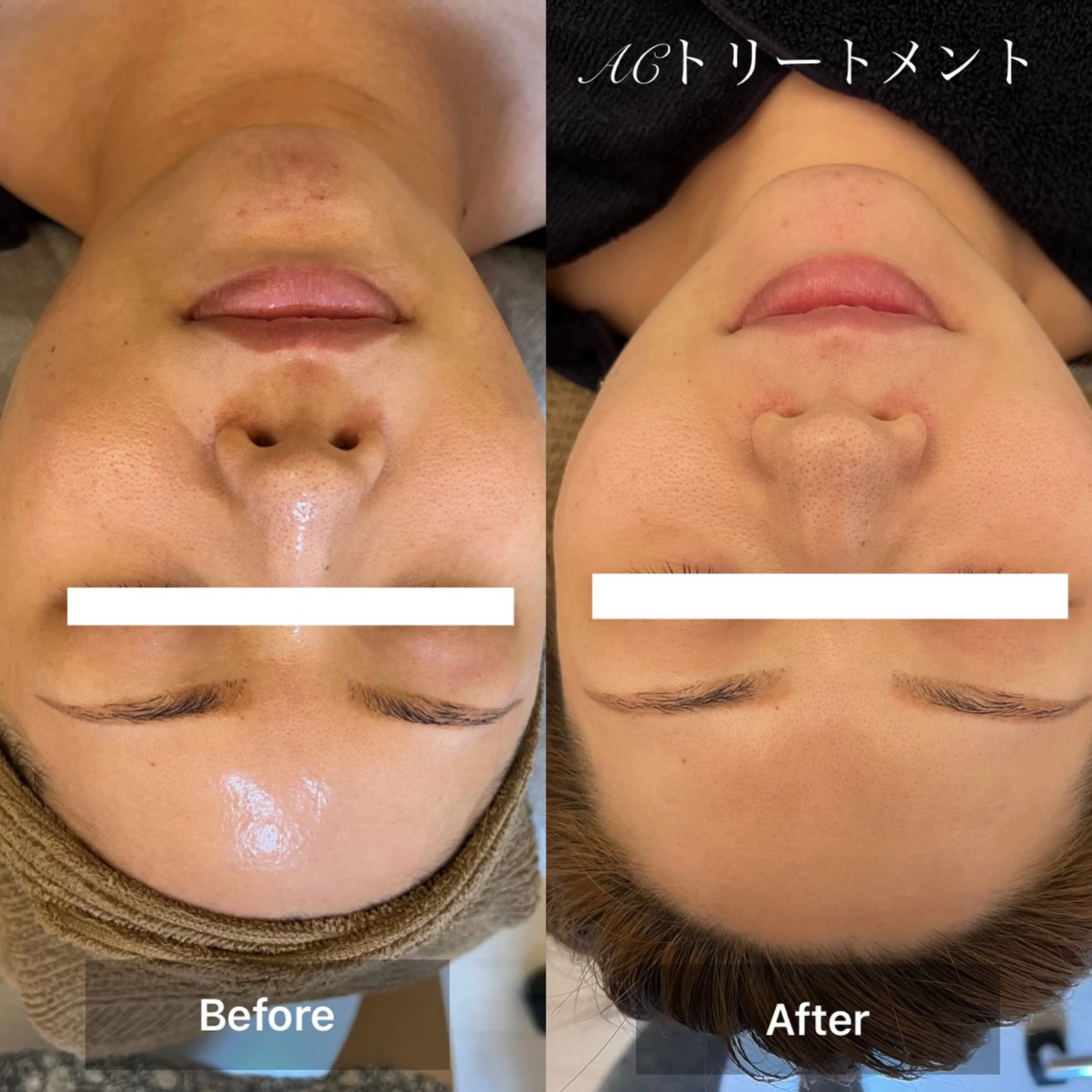 【肌質改善×リバースエイジング】最高峰の肌質改善トリートメント¥27,500⇒¥17,875の写真