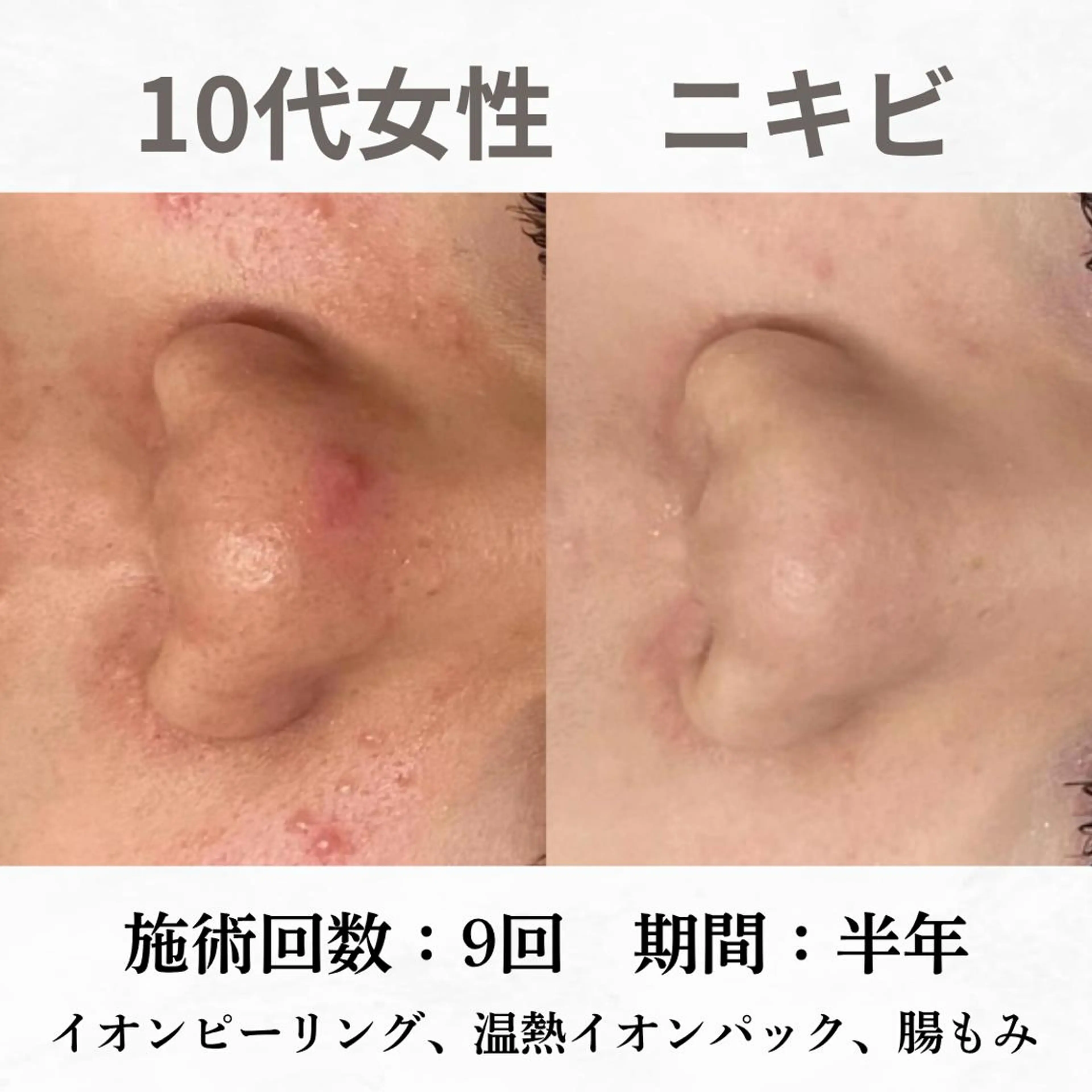 重度ニキビ専門🌷 ダウンタイムなしのエステ・リラクイメージ