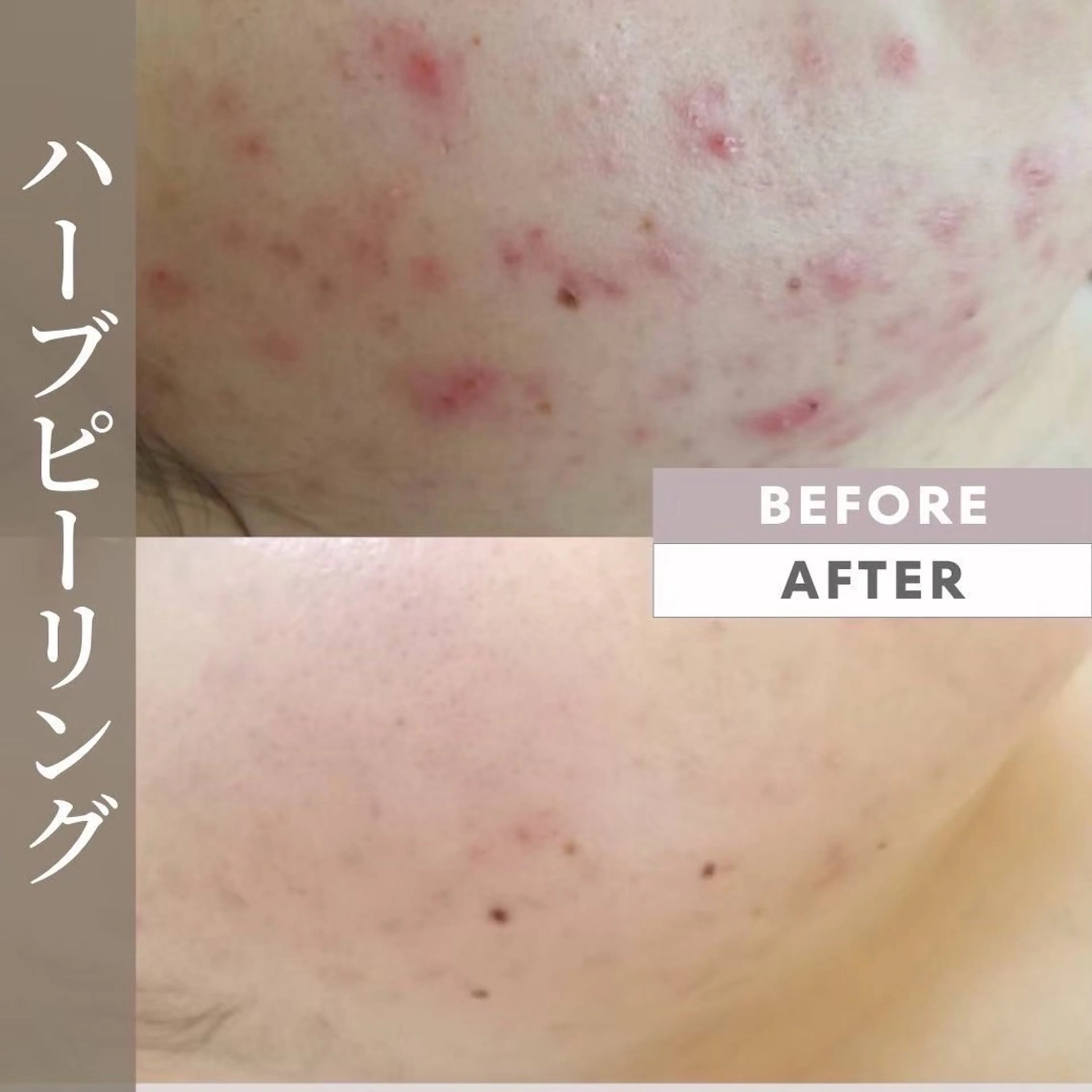 赤ニキビ・赤みには剥離無しフルーツ酸ピーリング🍎初回体験¥5,000の写真