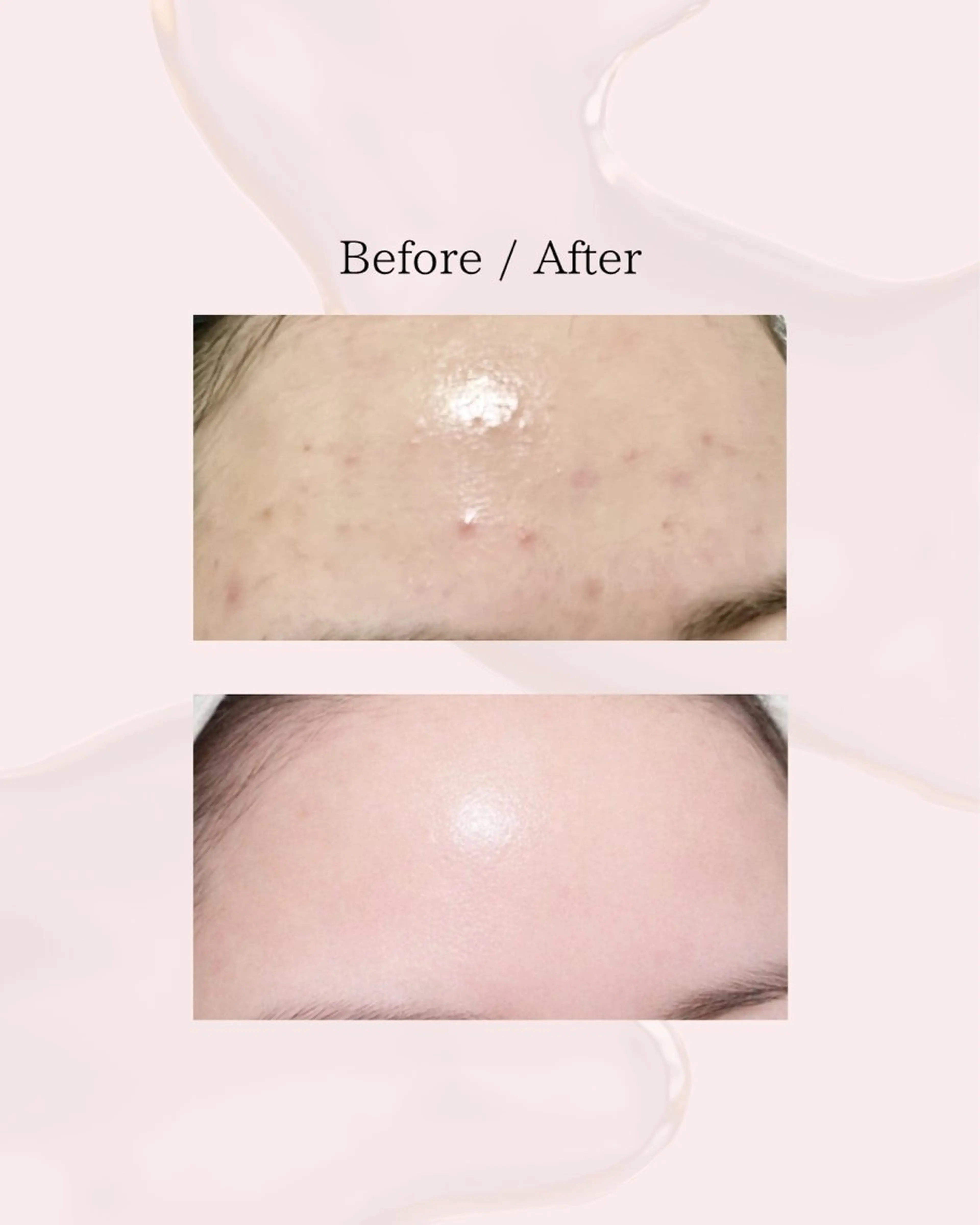 エステ myherb所属・ニキビ肌改善 ハーブピーリング🌿のエステ・リラクイメージ